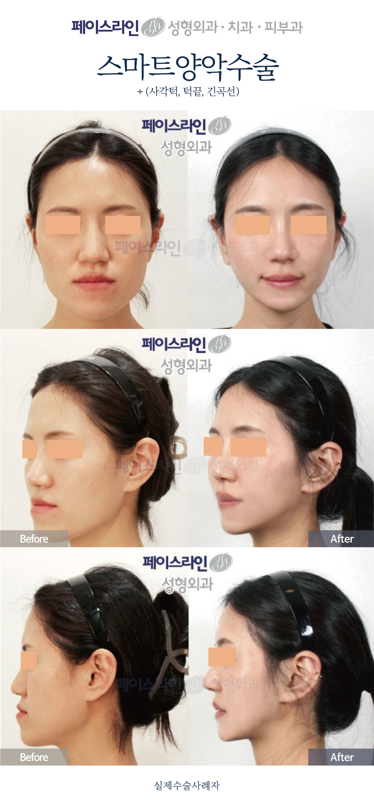 Double jaw surgery with chin and jawline procedures before and after at Faceline Plastic Surgery