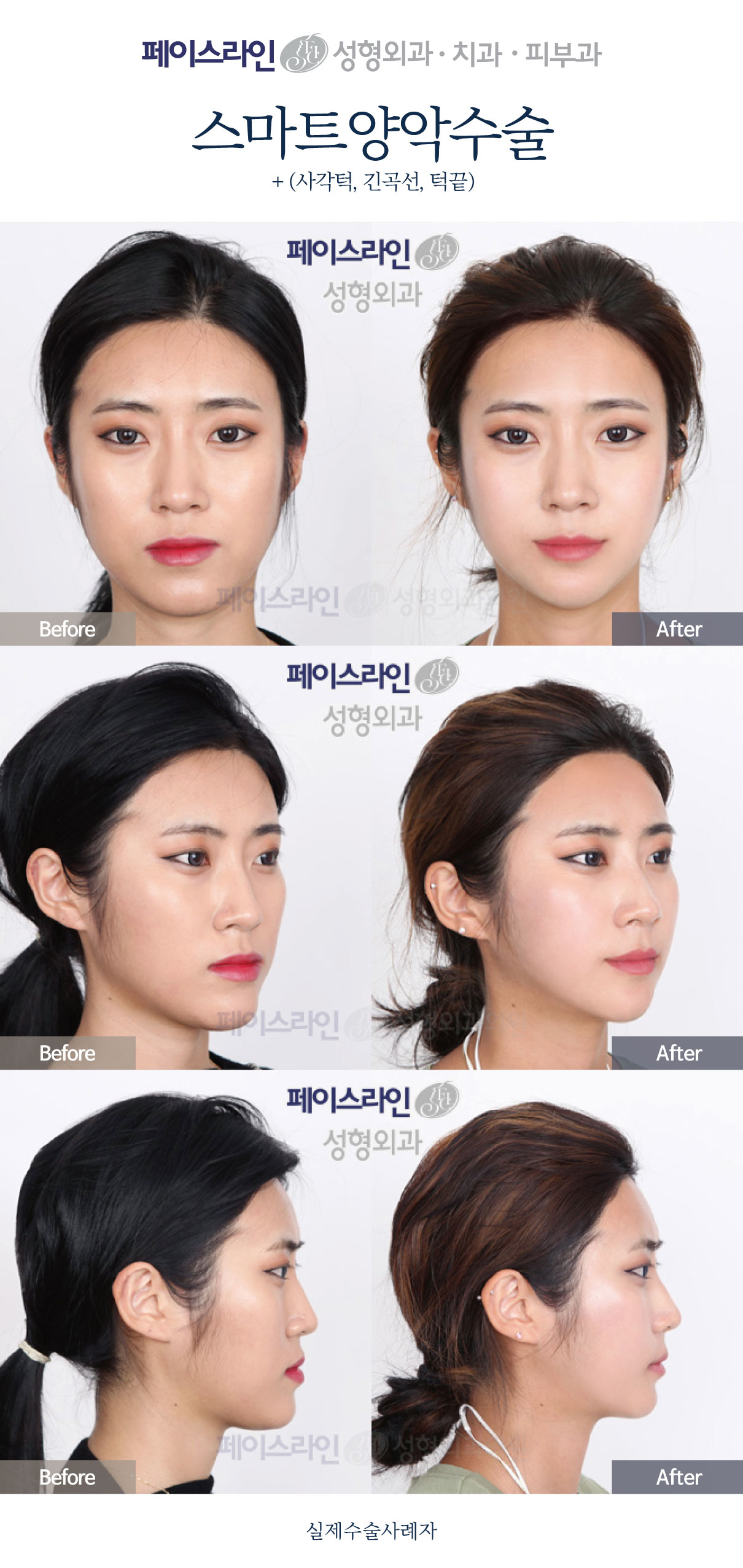 Double jaw surgery with chin and long-curve jaw contouring before and after at Faceline Plastic Surgery