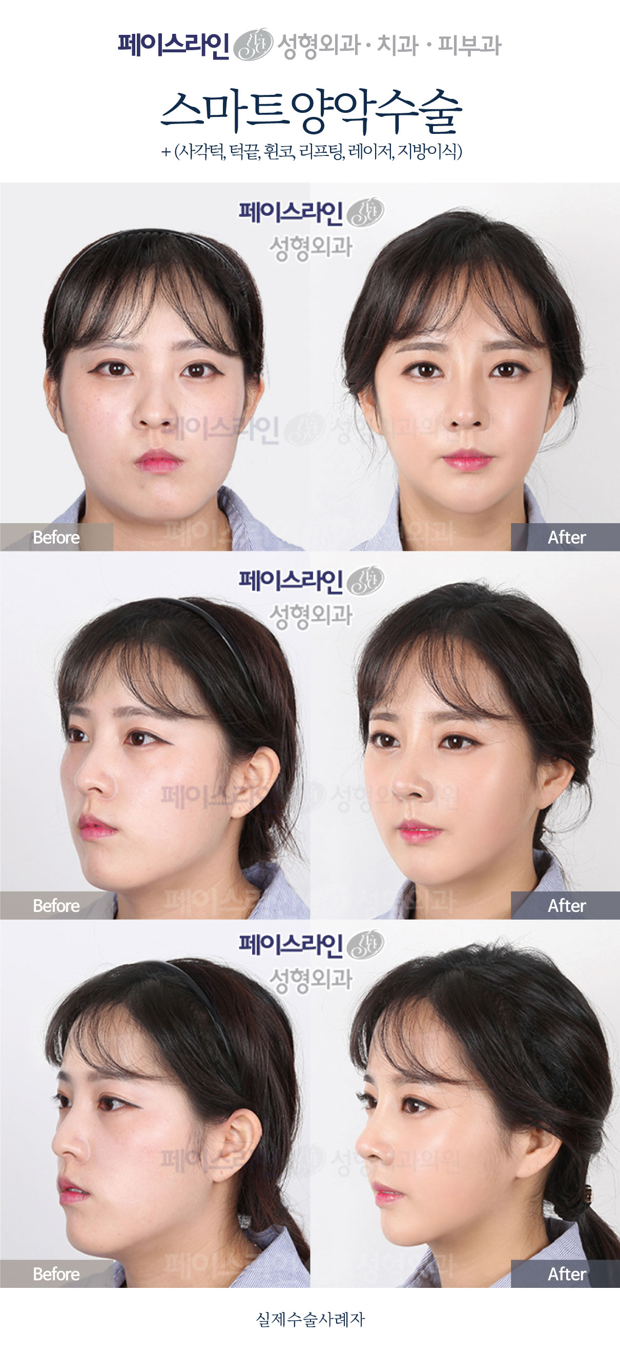 Double jaw surgery with contouring, lifting and fat grafting before and after at Faceline Plastic Surgery