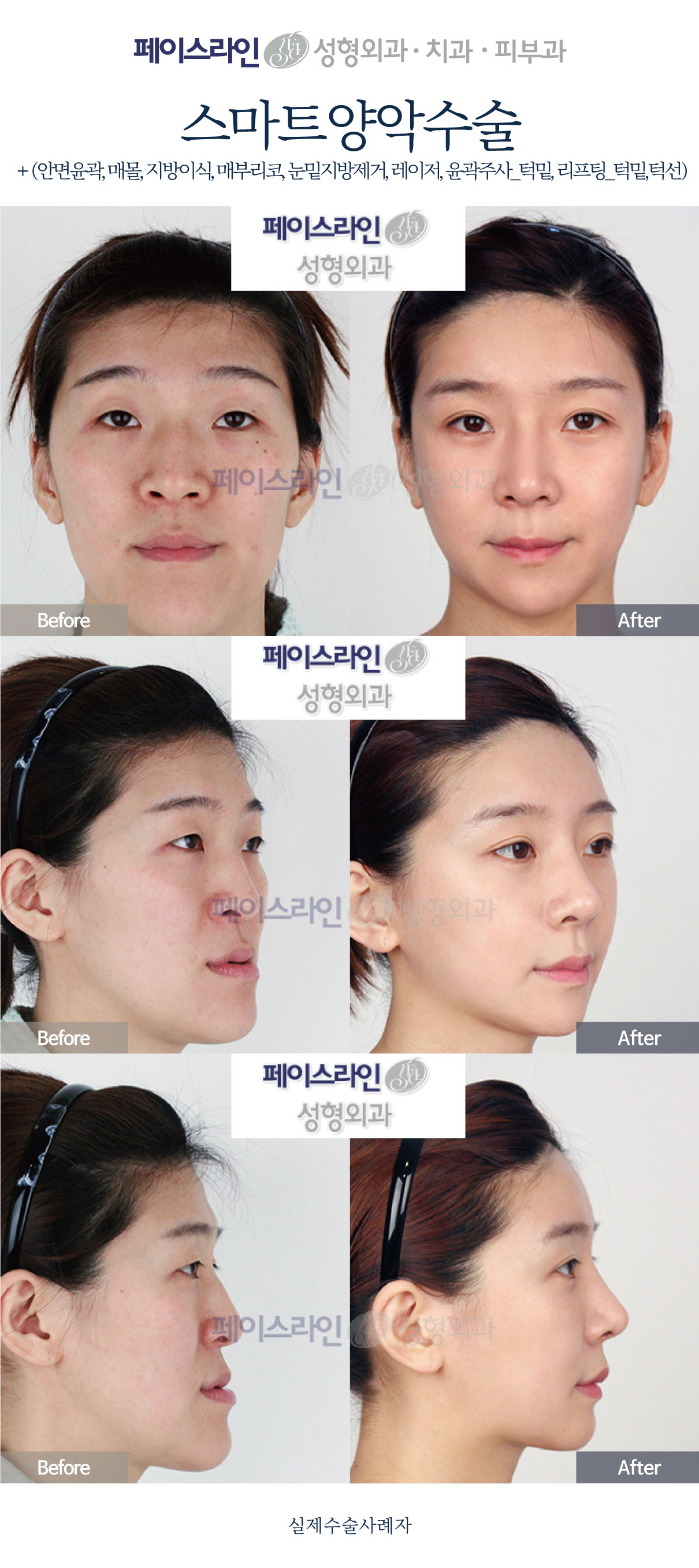 Double jaw surgery with eyelid, fat-grafting and lifting procedures before and after at Faceline Plastic Surgery