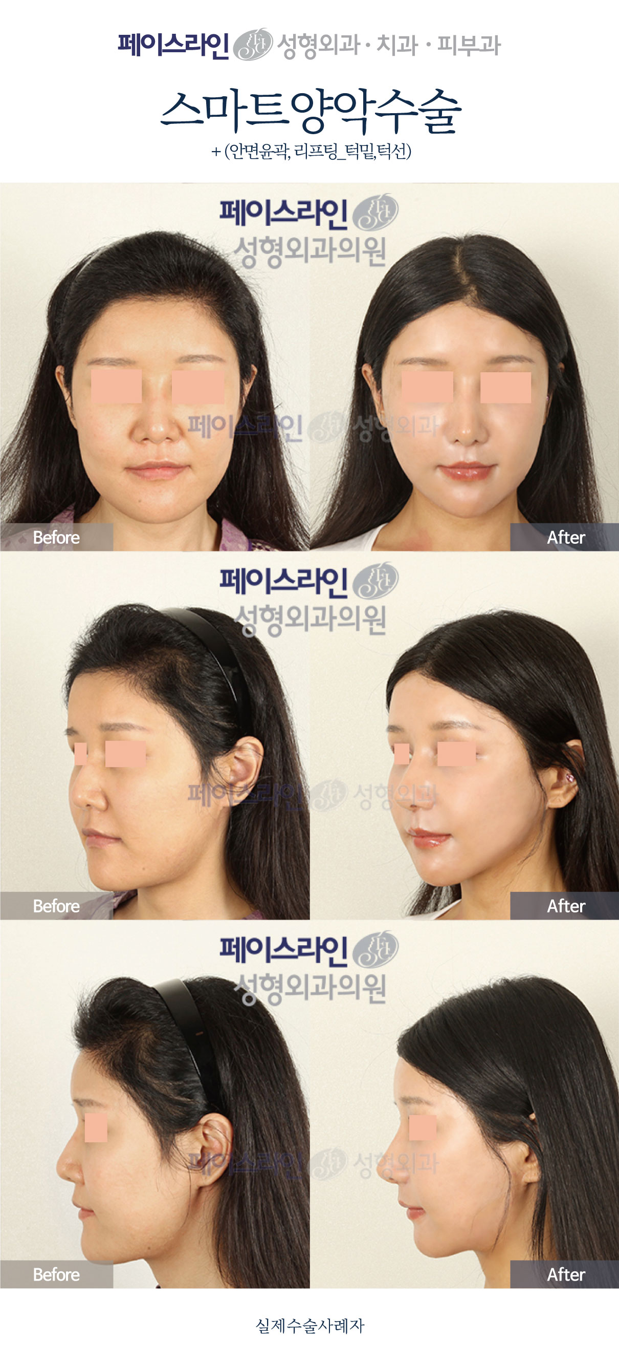 Double jaw surgery with facial contouring and lifting before and after at Faceline Plastic Surgery
