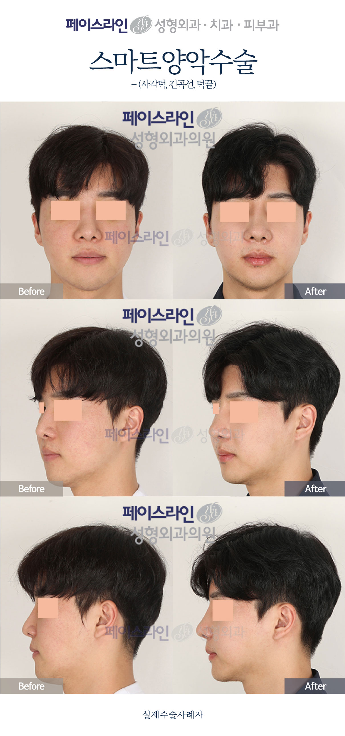 Double jaw surgery with jaw and chin reshaping before and after at Faceline Plastic Surgery