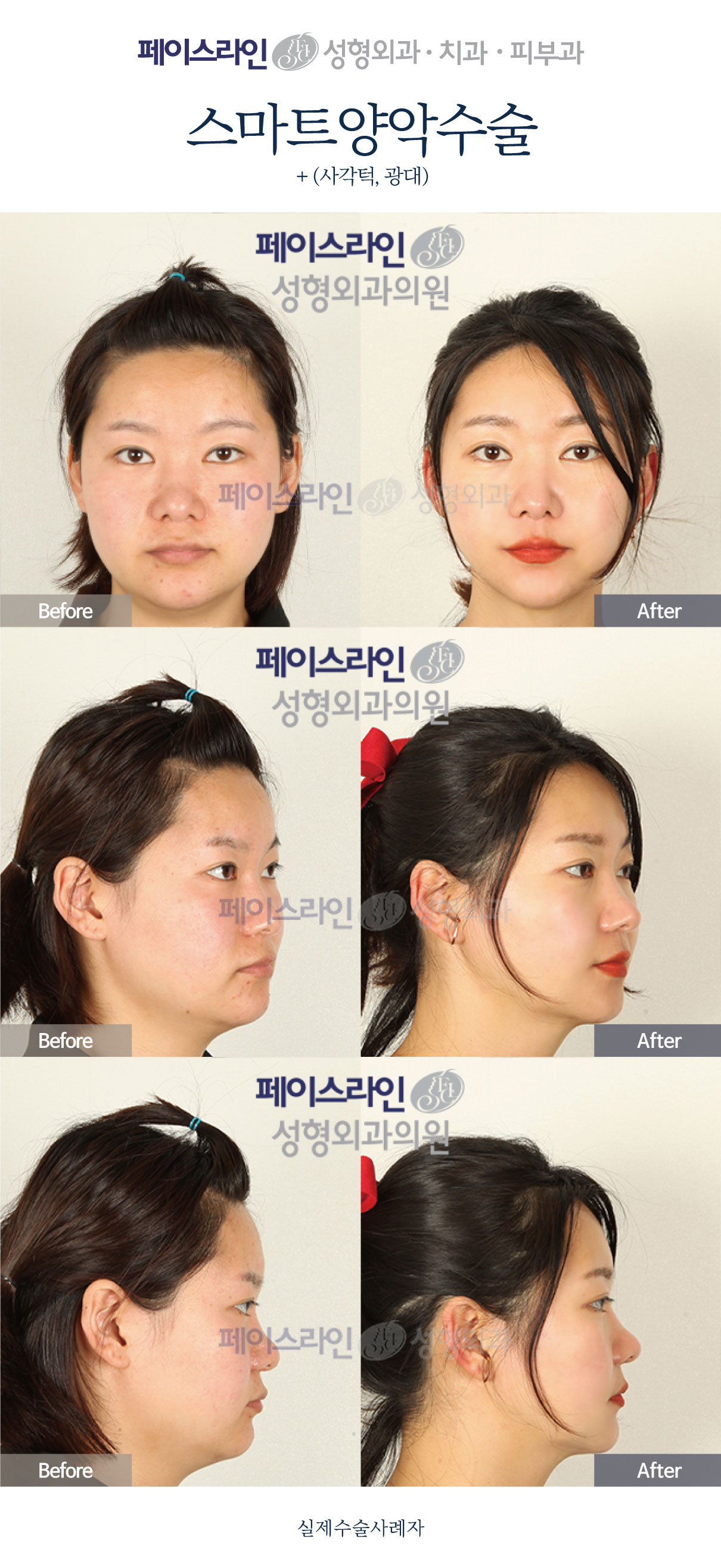 Double jaw surgery with jaw-angle and cheekbone procedures before and after at Faceline Plastic Surgery