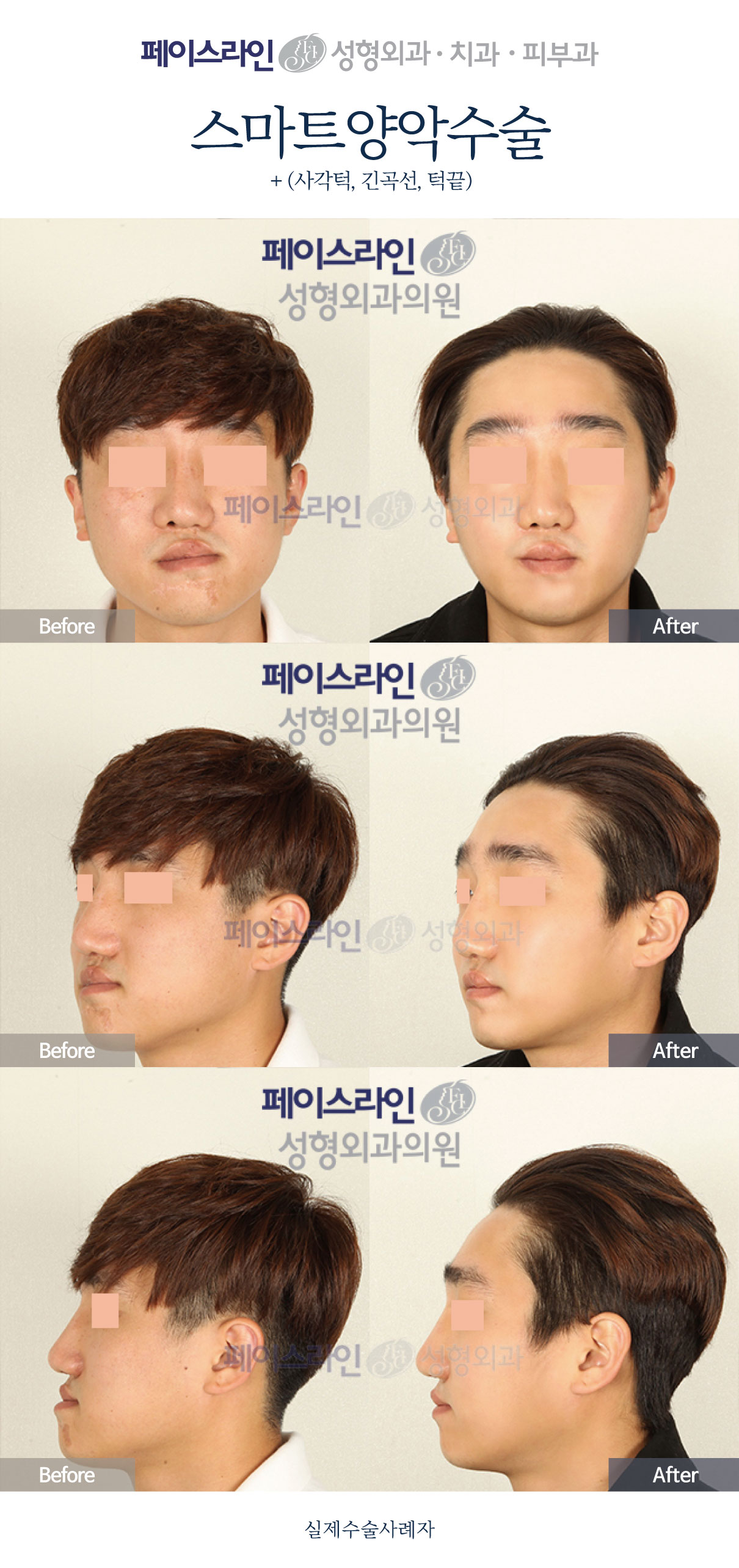 Double jaw surgery with jaw-angle and chin contouring before and after at Faceline Plastic Surgery