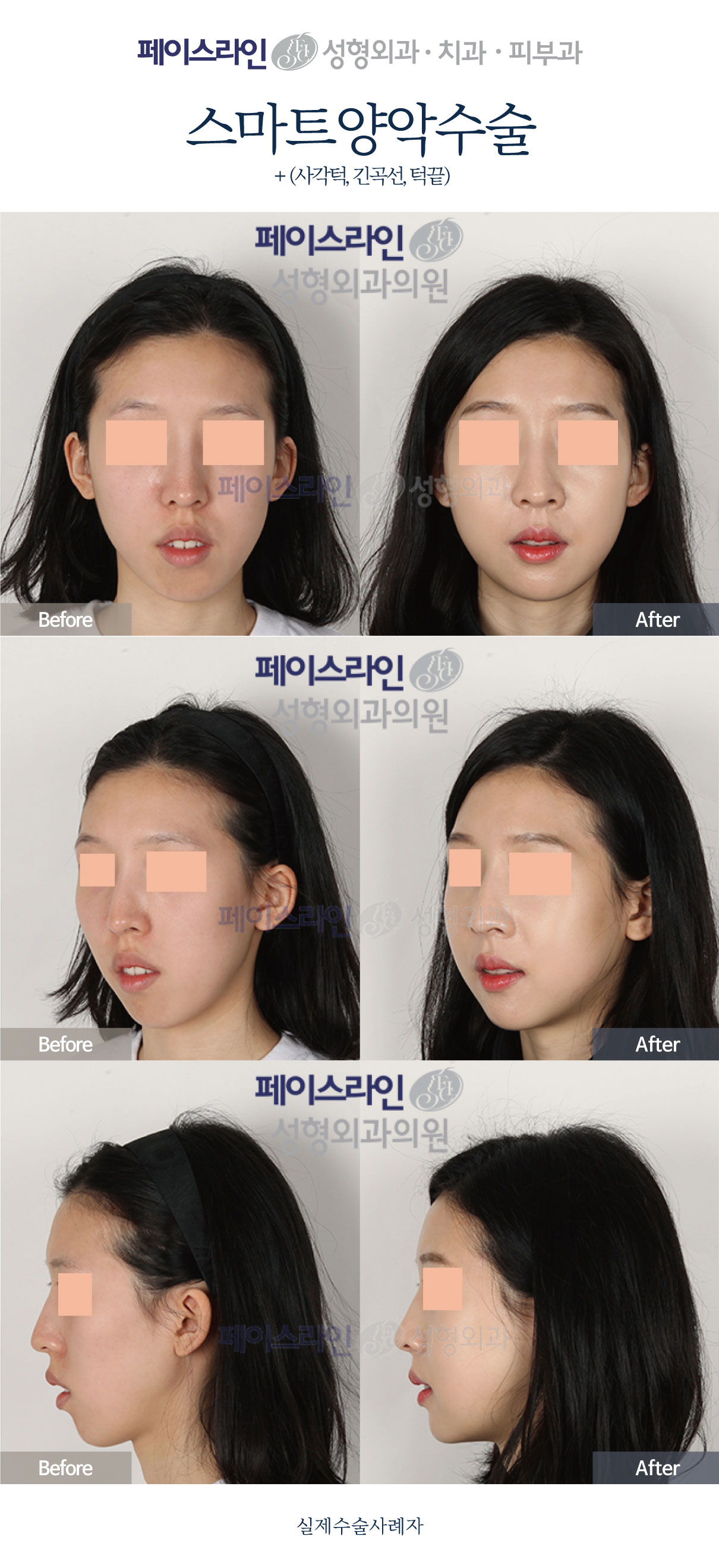 Double jaw surgery with jaw-angle, long-curve and chin procedures before and after at Faceline Plastic Surgery