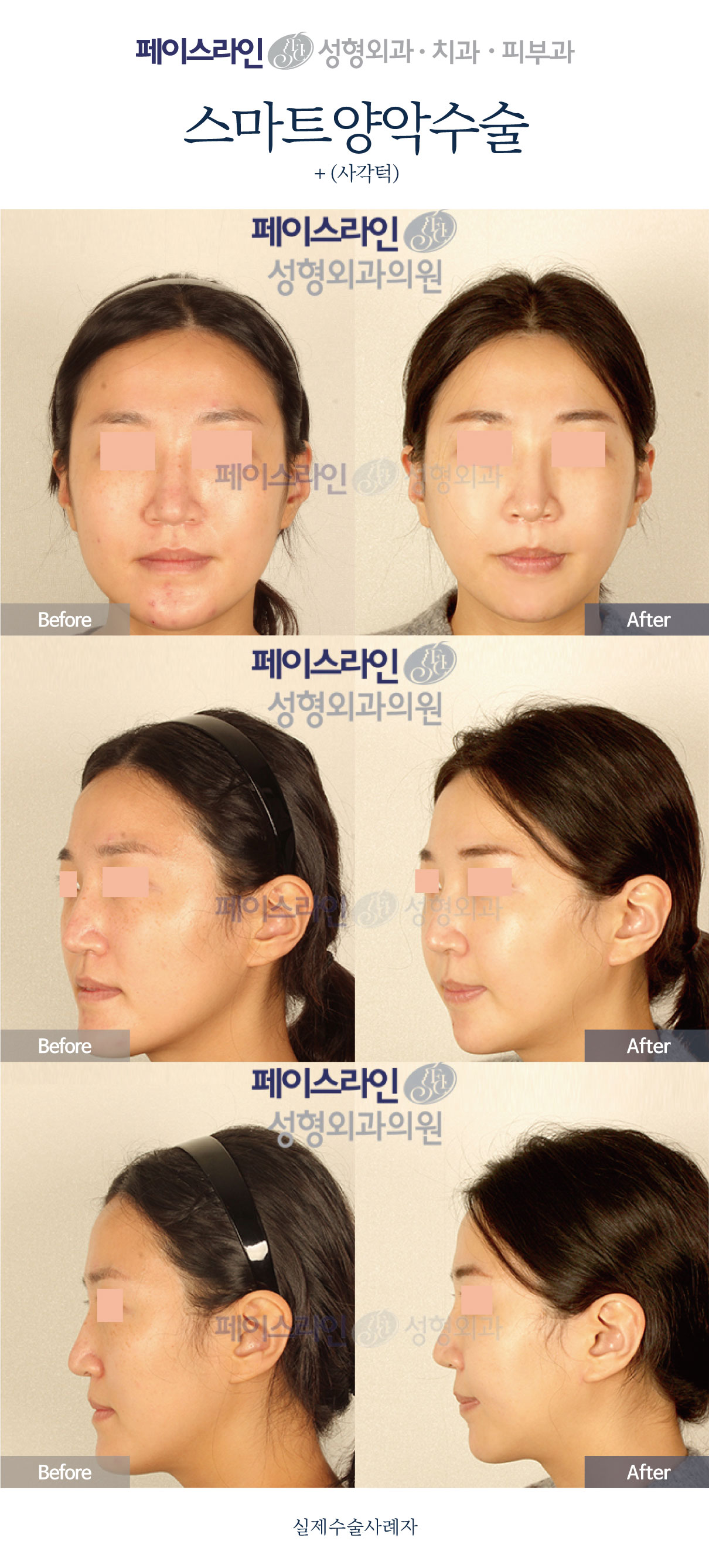 Double jaw surgery with jaw-angle reduction: comparison 01 before and after at Faceline Plastic Surgery
