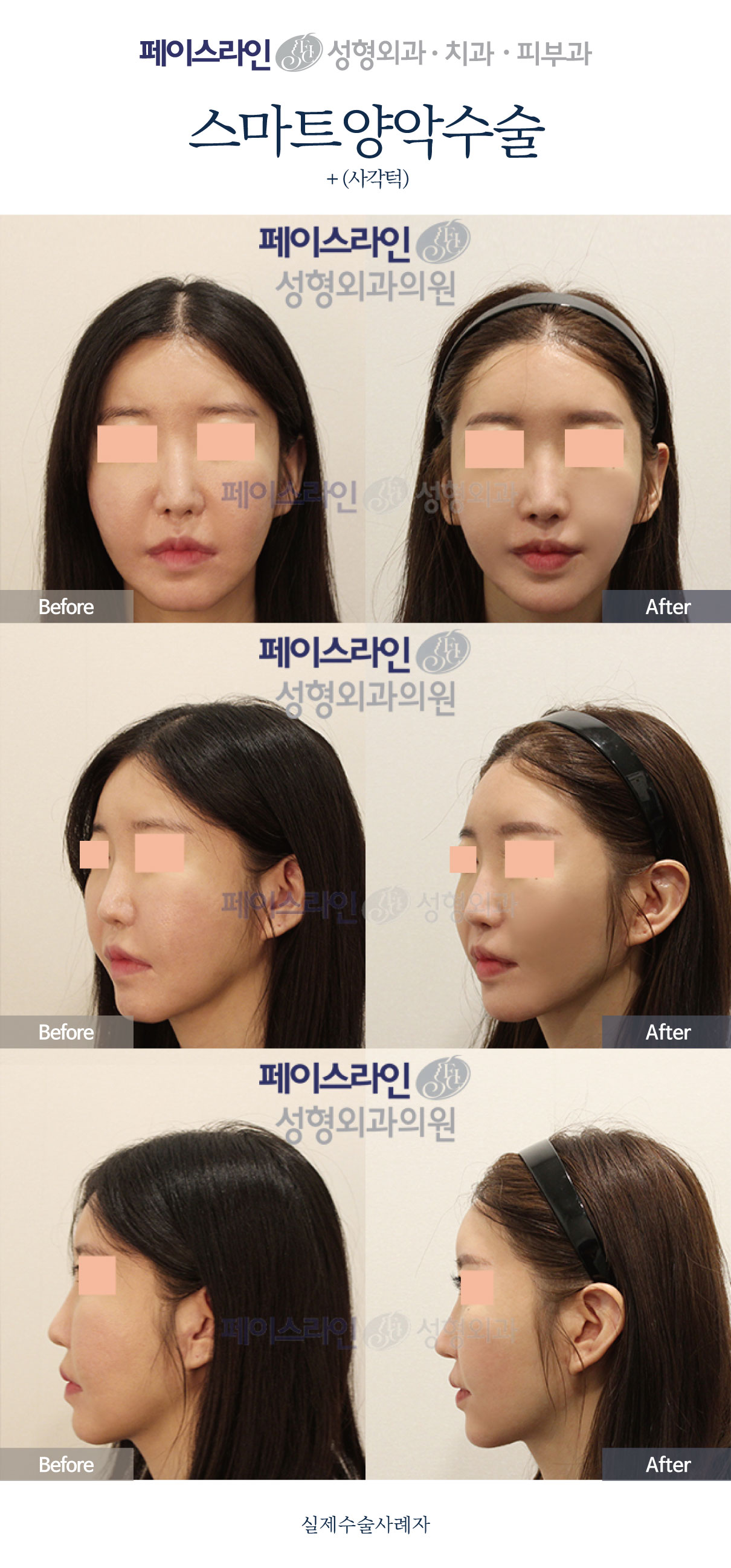 Double jaw surgery with jaw-angle reduction: comparison 02 before and after at Faceline Plastic Surgery