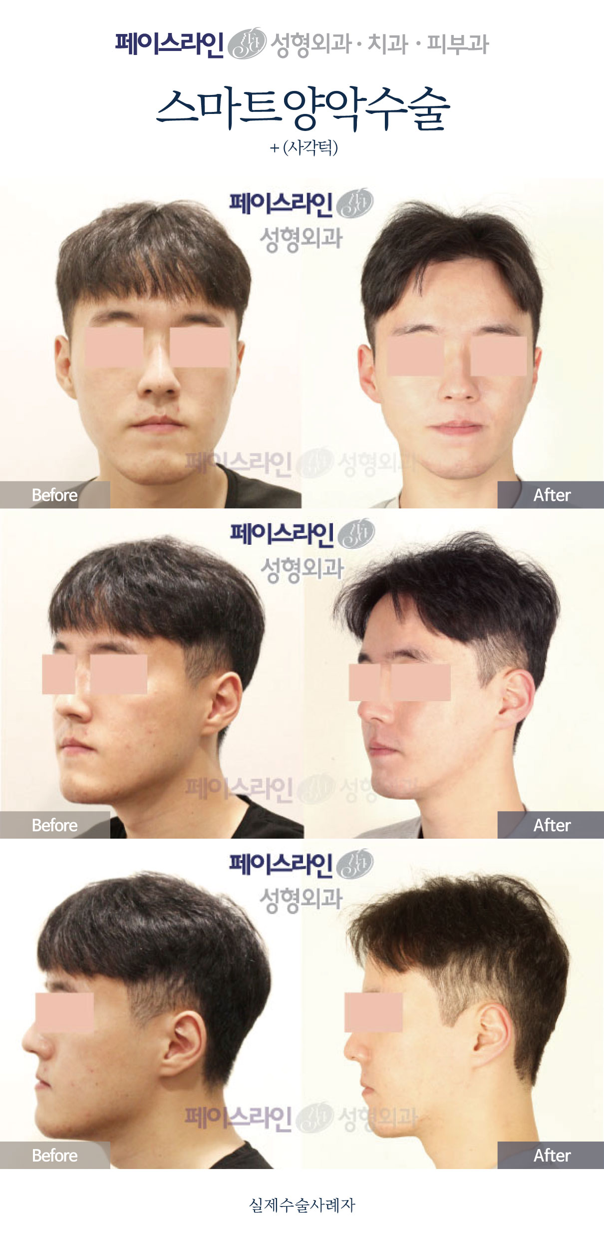 Double jaw surgery with jaw-angle reduction: comparison 03 before and after at Faceline Plastic Surgery