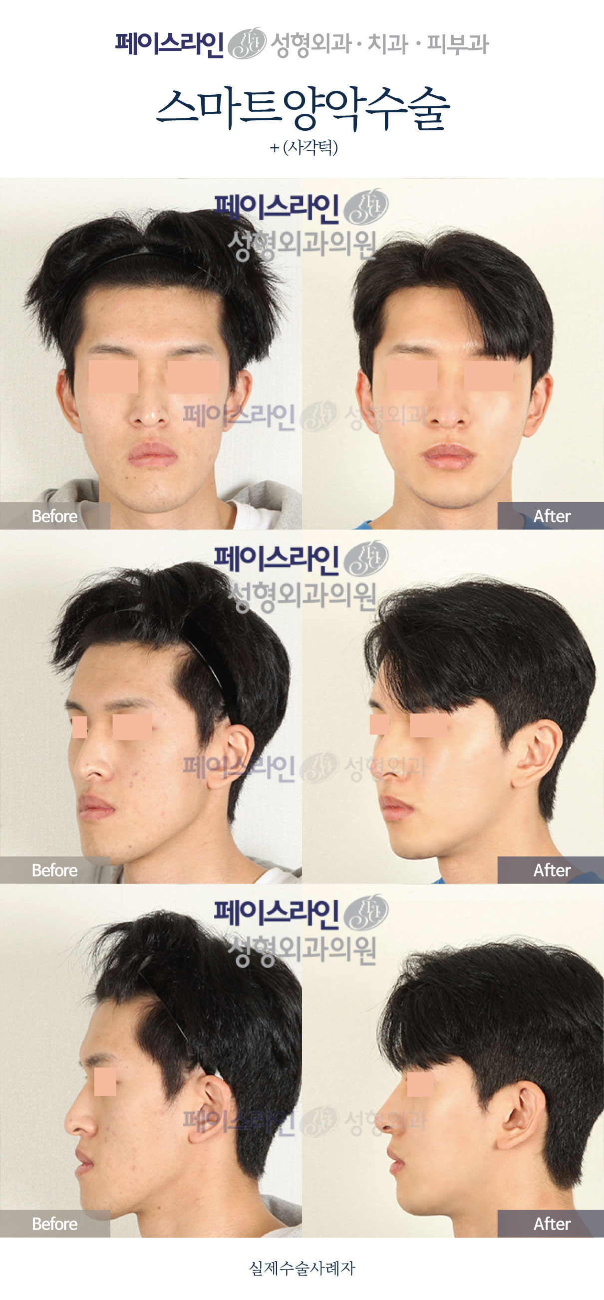 Double jaw surgery with jaw-angle reduction: comparison 04 before and after at Faceline Plastic Surgery