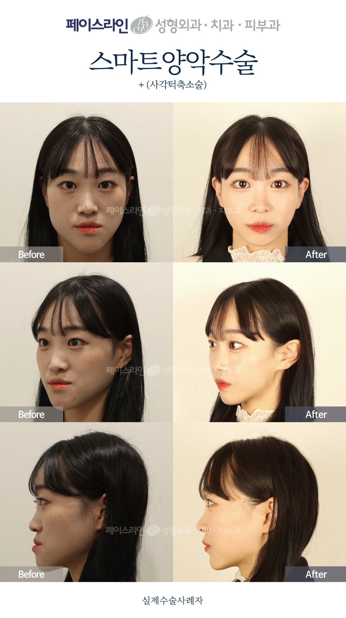 Double jaw surgery with jaw-angle reduction: comparison 05 before and after at Faceline Plastic Surgery