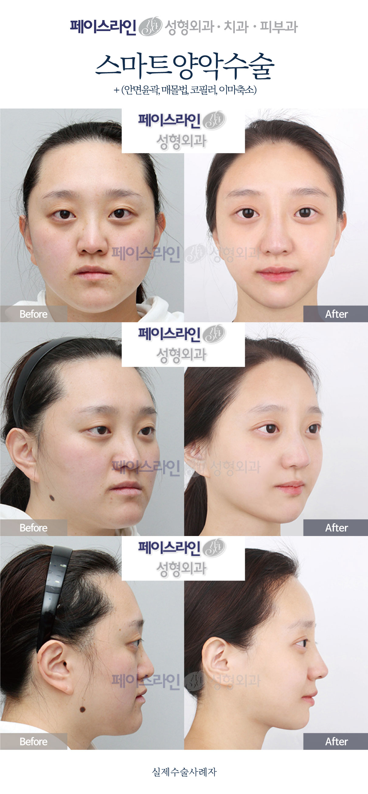 Double jaw surgery with nose and forehead reduction before and after at Faceline Plastic Surgery