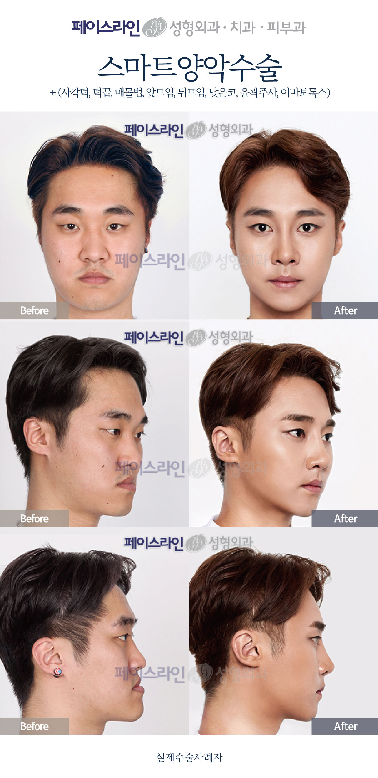 Double jaw surgery with nose, eyelid and chin procedures before and after at Faceline Plastic Surgery