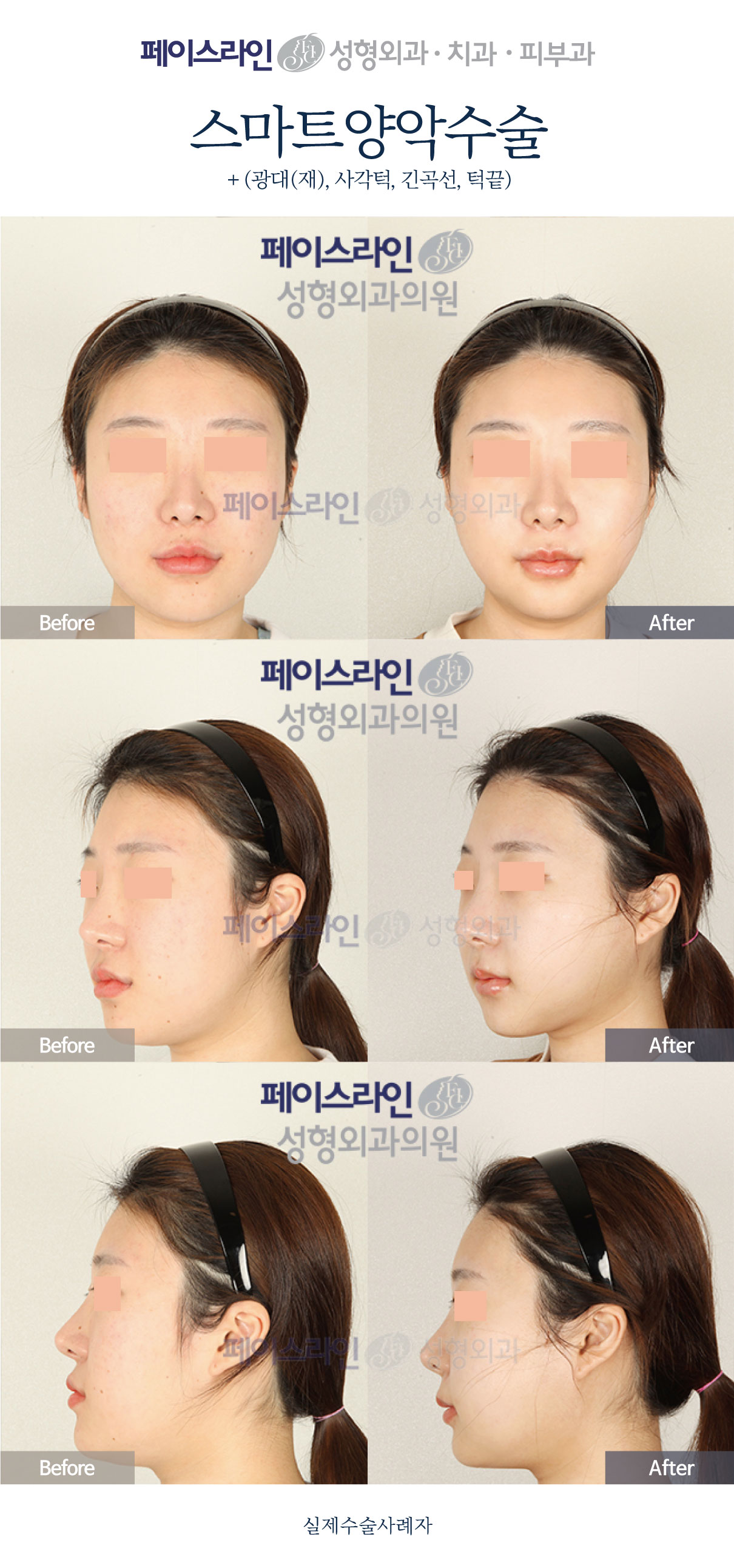 Double jaw surgery with revision cheekbone and chin procedures before and after at Faceline Plastic Surgery