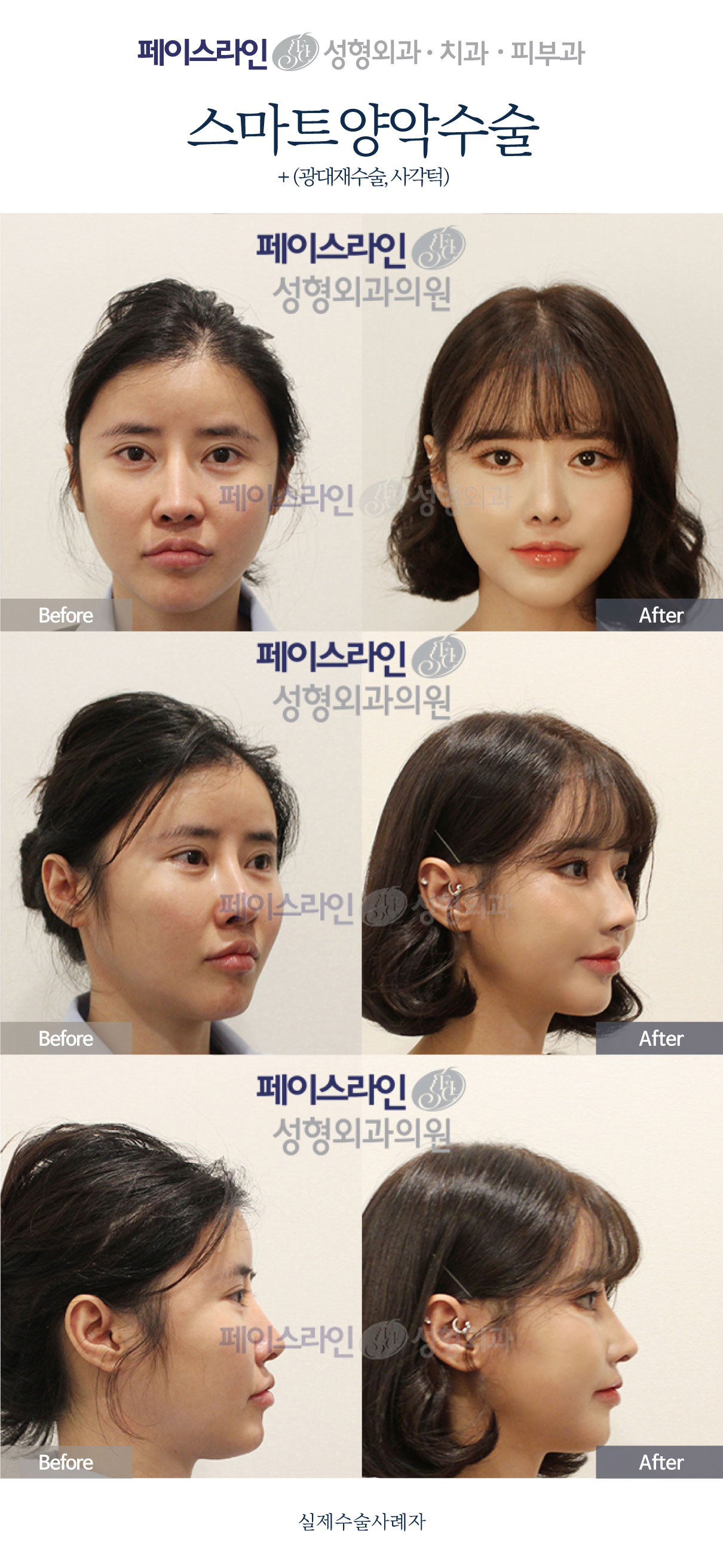 Double jaw surgery with revision cheekbone contouring before and after at Faceline Plastic Surgery