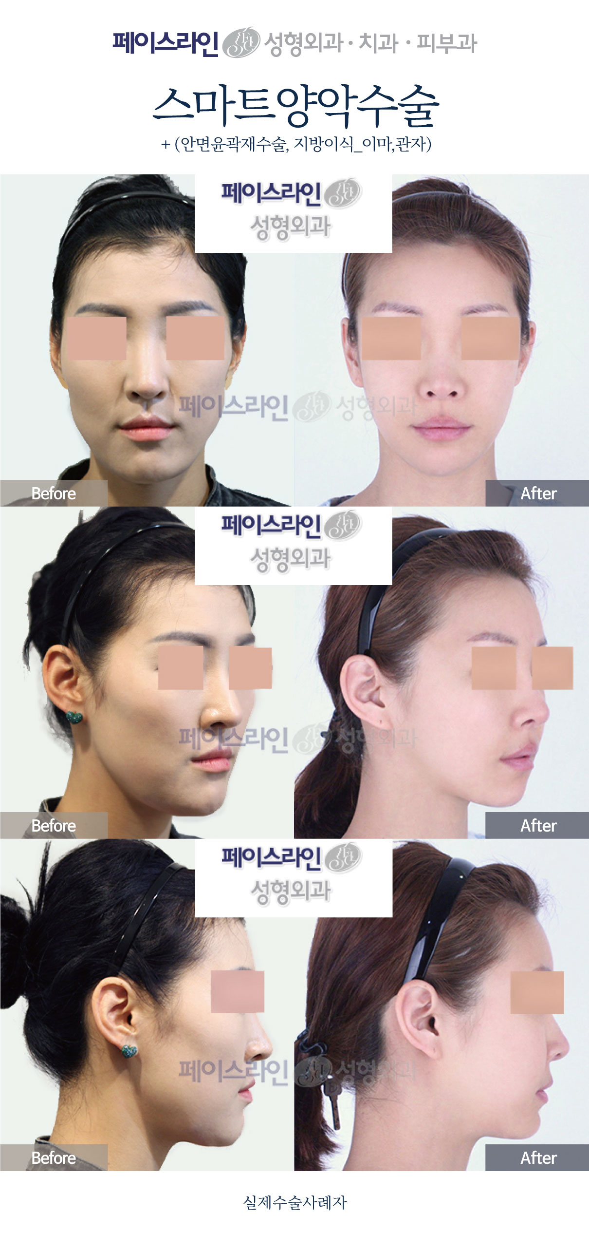 Double jaw surgery with revision contouring and facial fat grafting before and after at Faceline Plastic Surgery