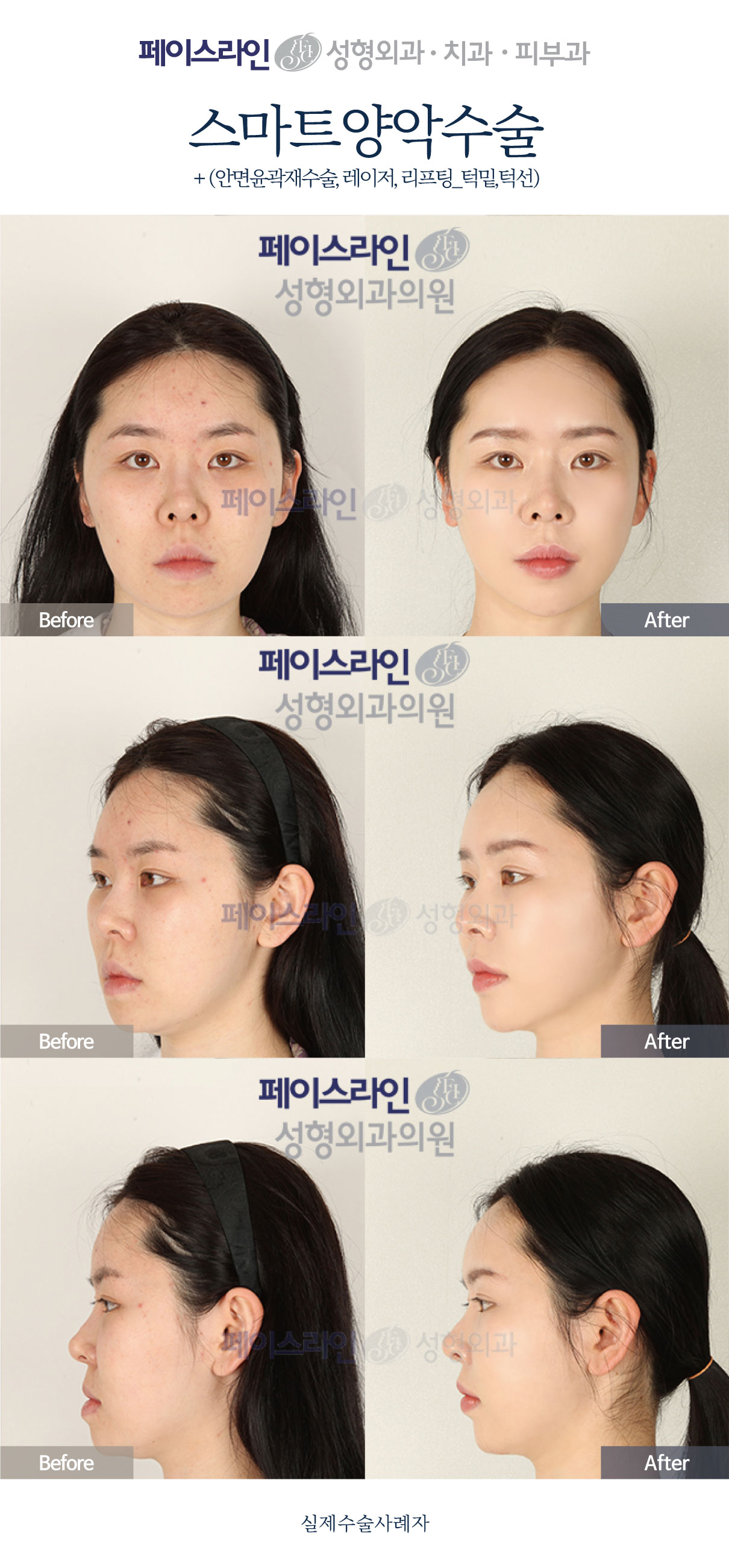 Double jaw surgery with revision contouring and laser lifting before and after at Faceline Plastic Surgery