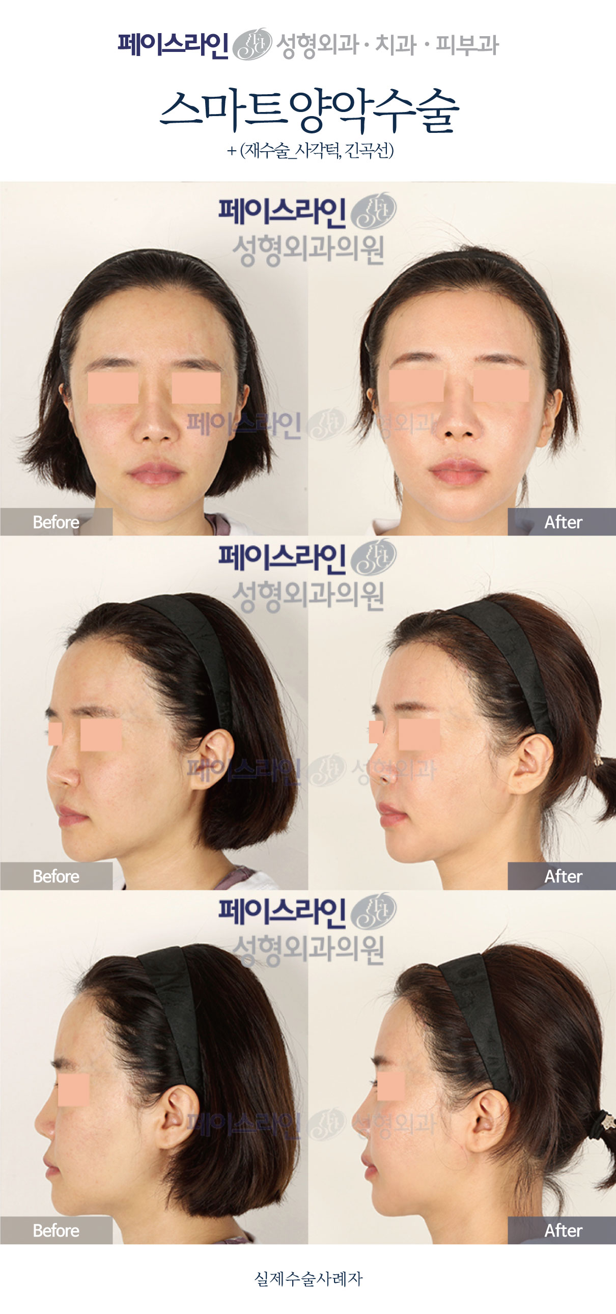 Double jaw surgery with revision jaw contouring before and after at Faceline Plastic Surgery