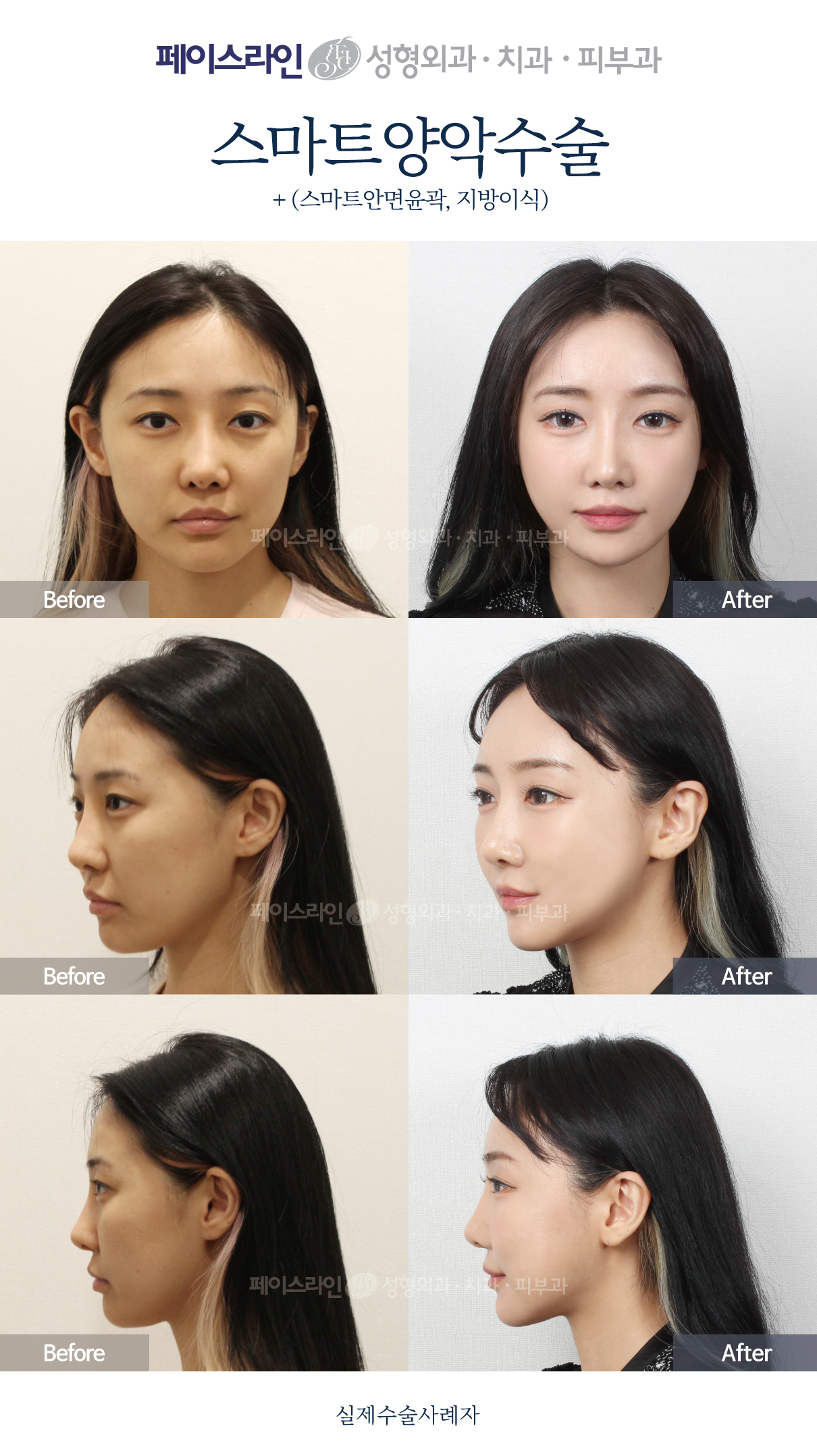 Double jaw surgery with Smart contouring and fat grafting before and after at Faceline Plastic Surgery