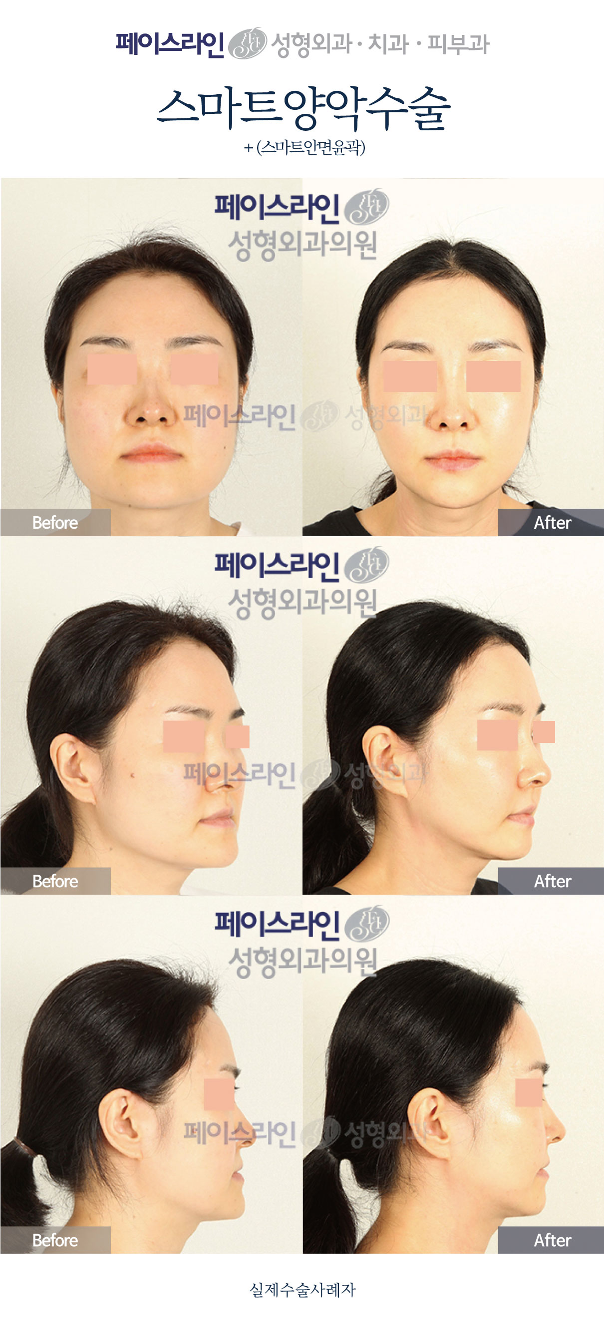 Double jaw surgery with Smart facial contouring before and after at Faceline Plastic Surgery