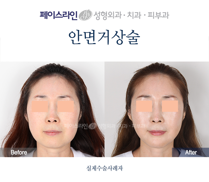 Facelift: front-view comparison before and after at Faceline Plastic Surgery