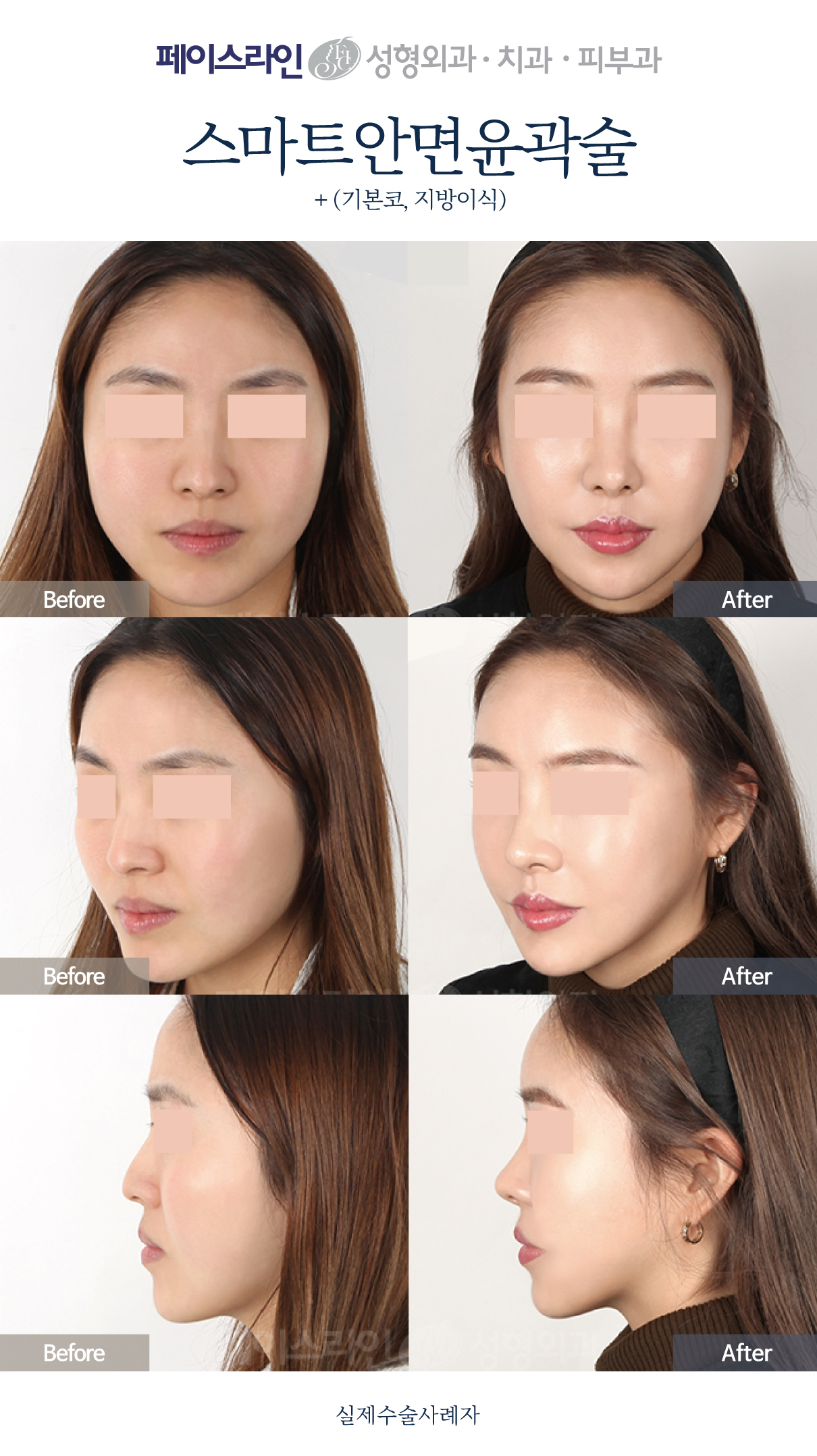 Facial contouring with crooked-nose correction and fat grafting before and after at Faceline Plastic Surgery