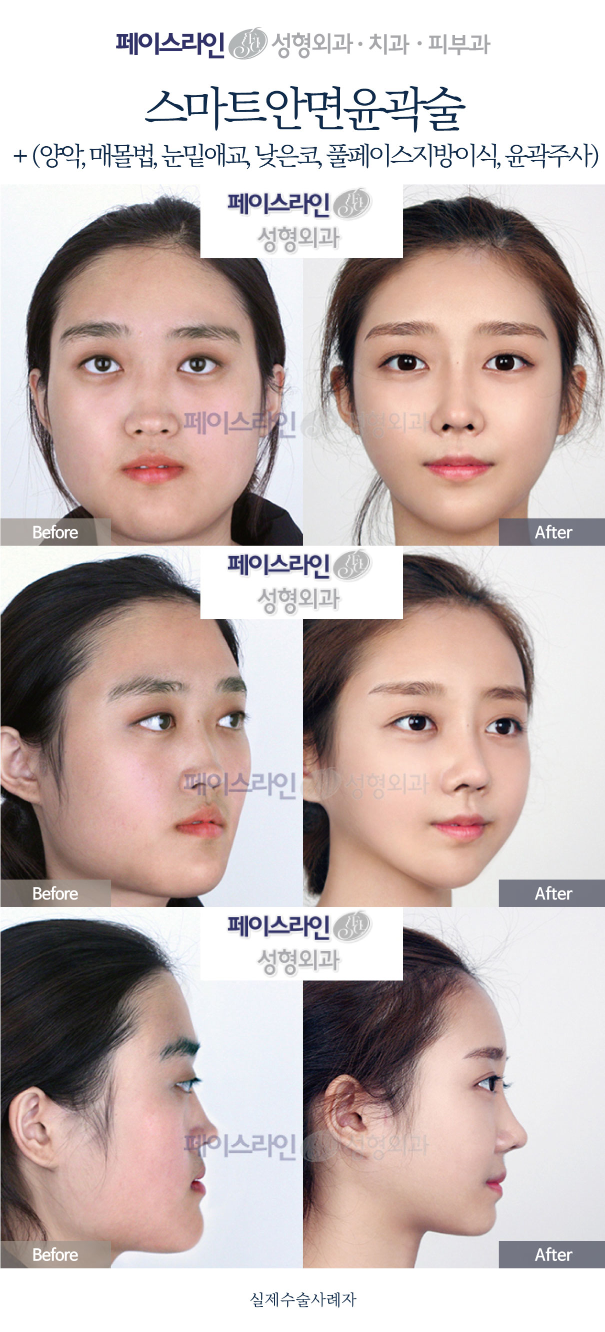 Facial contouring with double jaw, eyelid and nose procedures before and after at Faceline Plastic Surgery