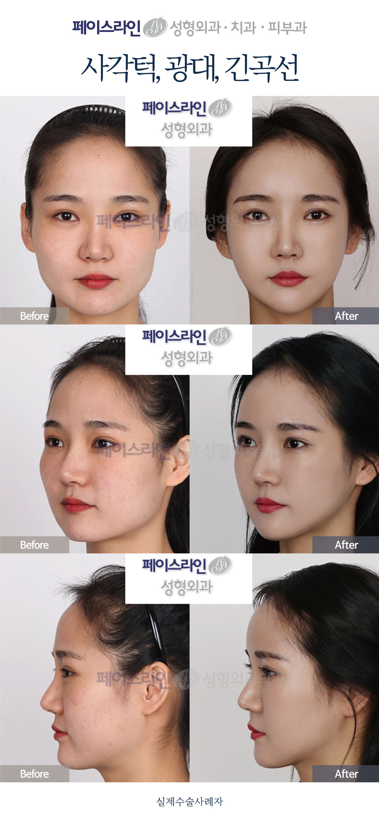 Jaw-angle and cheekbone contouring with long-curve reduction before and after at Faceline Plastic Surgery