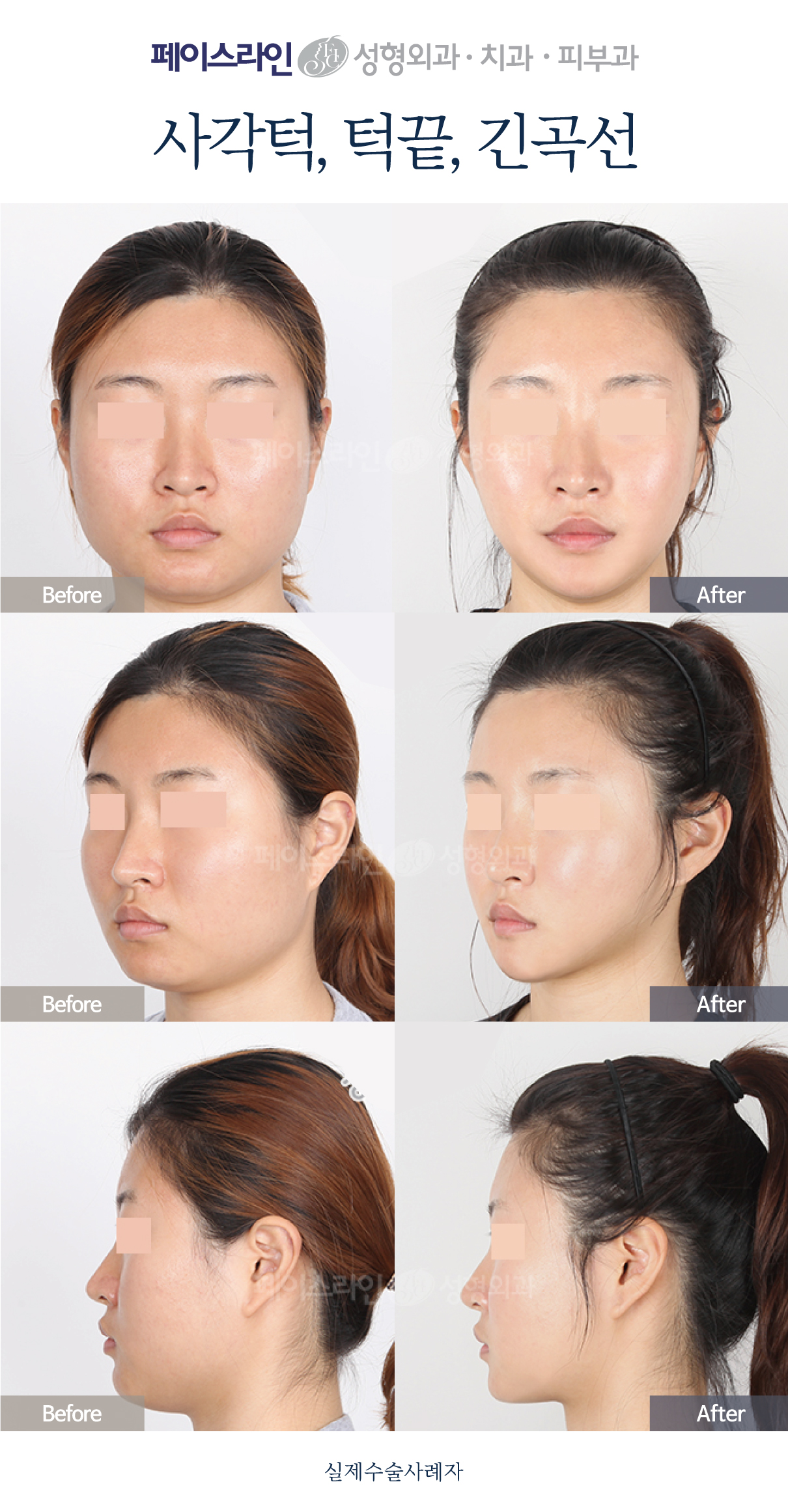 Jaw-angle and chin contouring with long-curve reduction before and after at Faceline Plastic Surgery