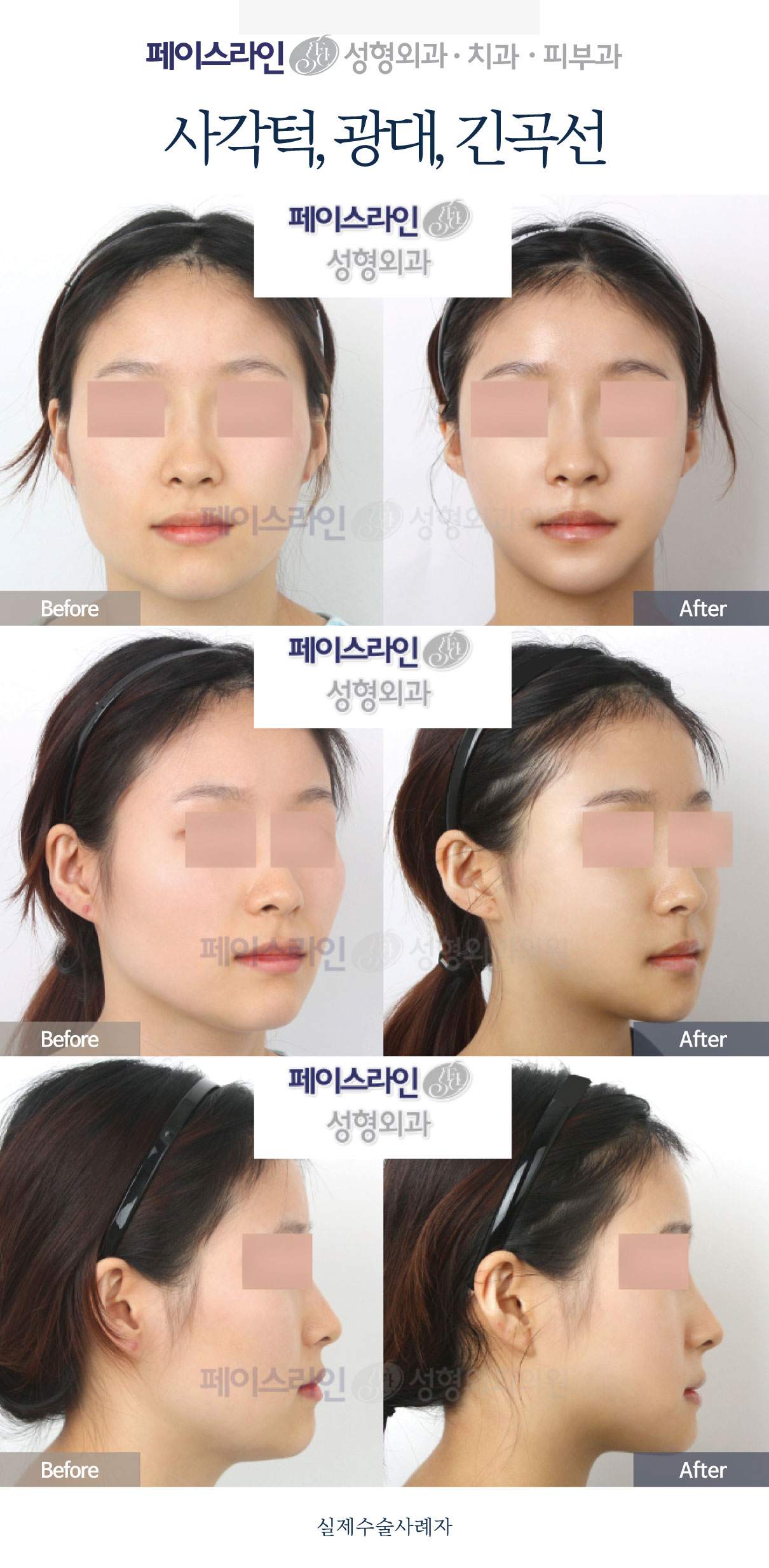Jaw-angle, cheekbone and long-curve contouring before and after at Faceline Plastic Surgery