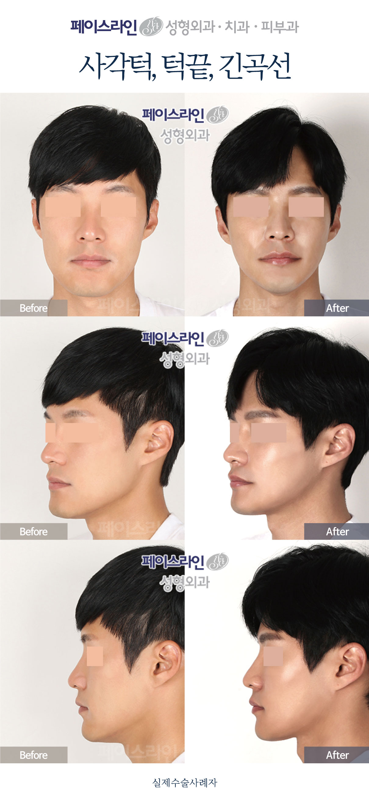 Jaw-angle, chin and long-curve contouring before and after at Faceline Plastic Surgery