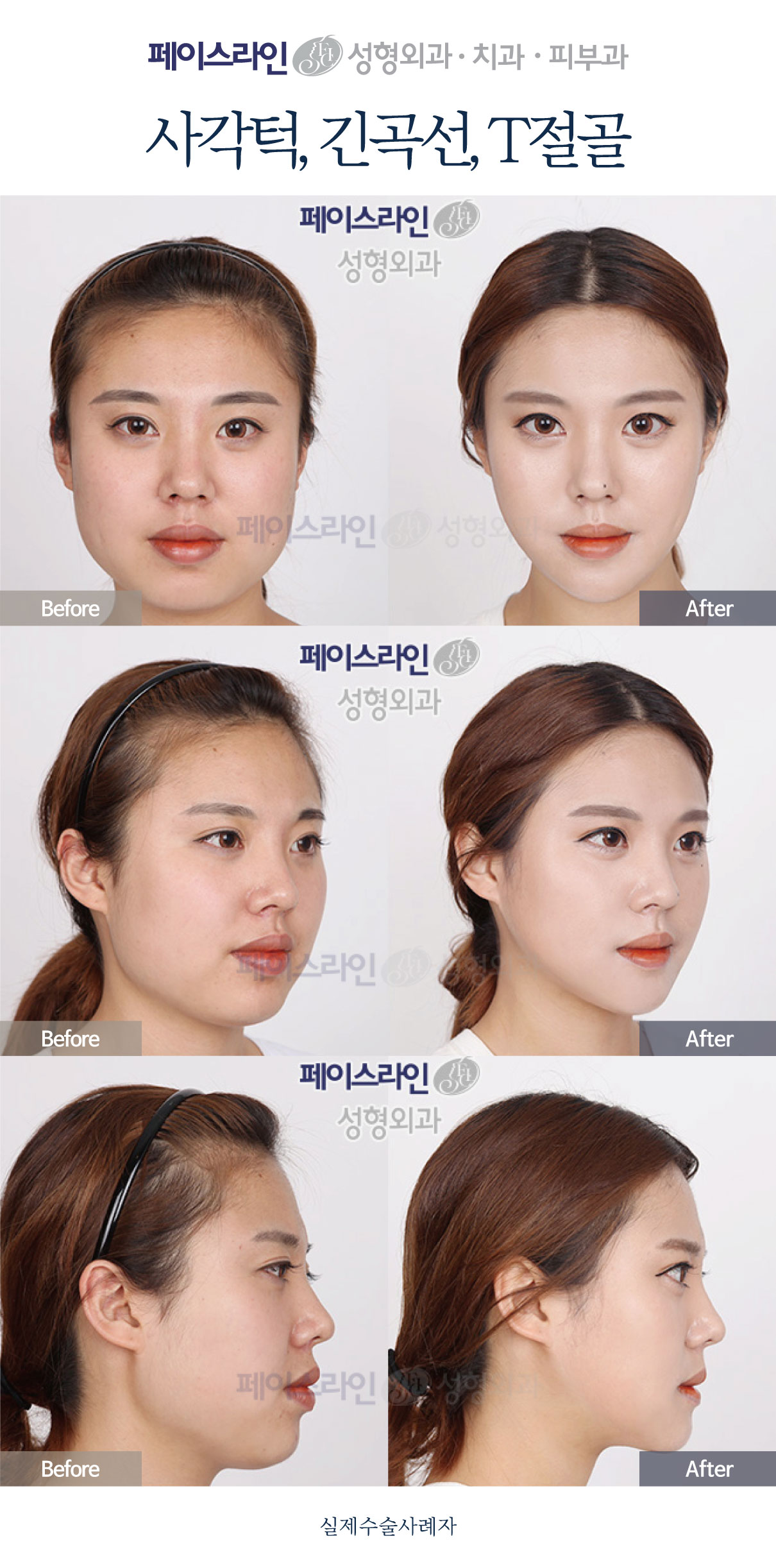 Jaw-angle reduction with T-osteotomy chin surgery before and after at Faceline Plastic Surgery