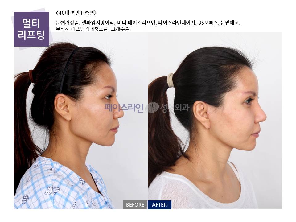 Multi-lifting with brow, cheekbone and nose surgery at Faceline Plastic Surgery: Profile view; before on the left and after on the right.
