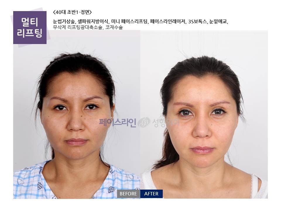 Multi-lifting with brow, cheekbone and nose surgery before and after at Faceline Plastic Surgery