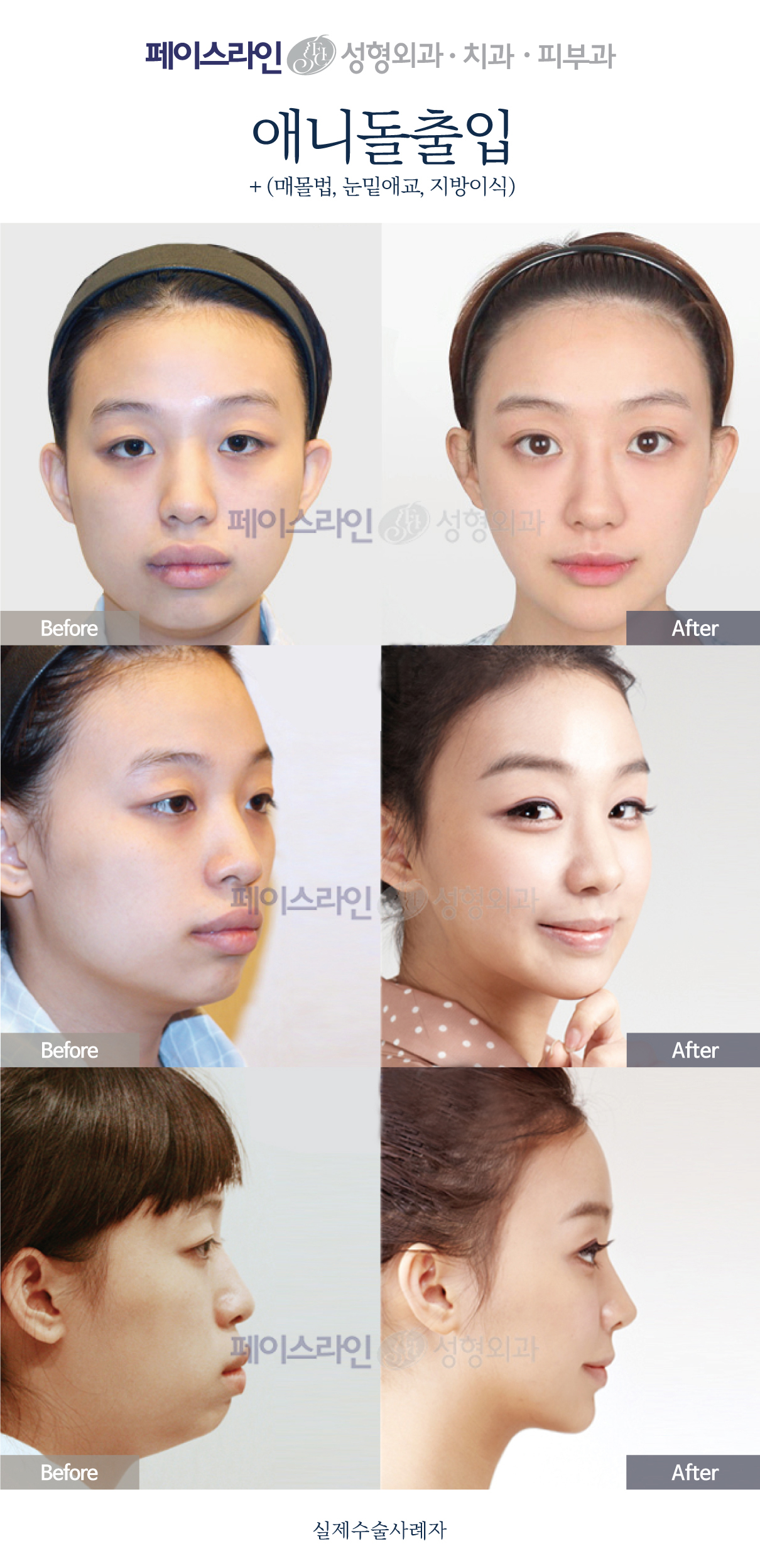 Protruding mouth surgery with eyelid correction and fat grafting before and after at Faceline Plastic Surgery