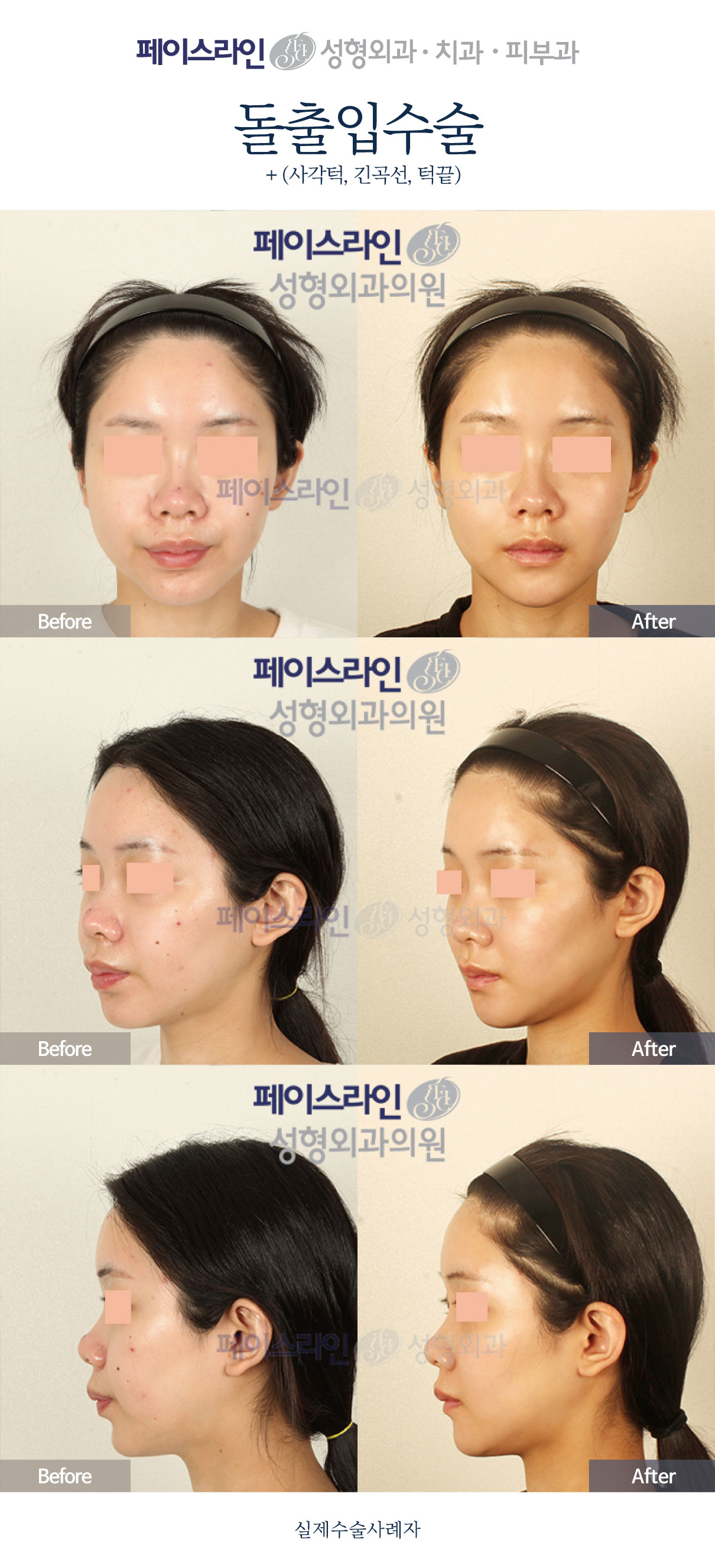 Protruding mouth surgery with jaw and chin contouring before and after at Faceline Plastic Surgery