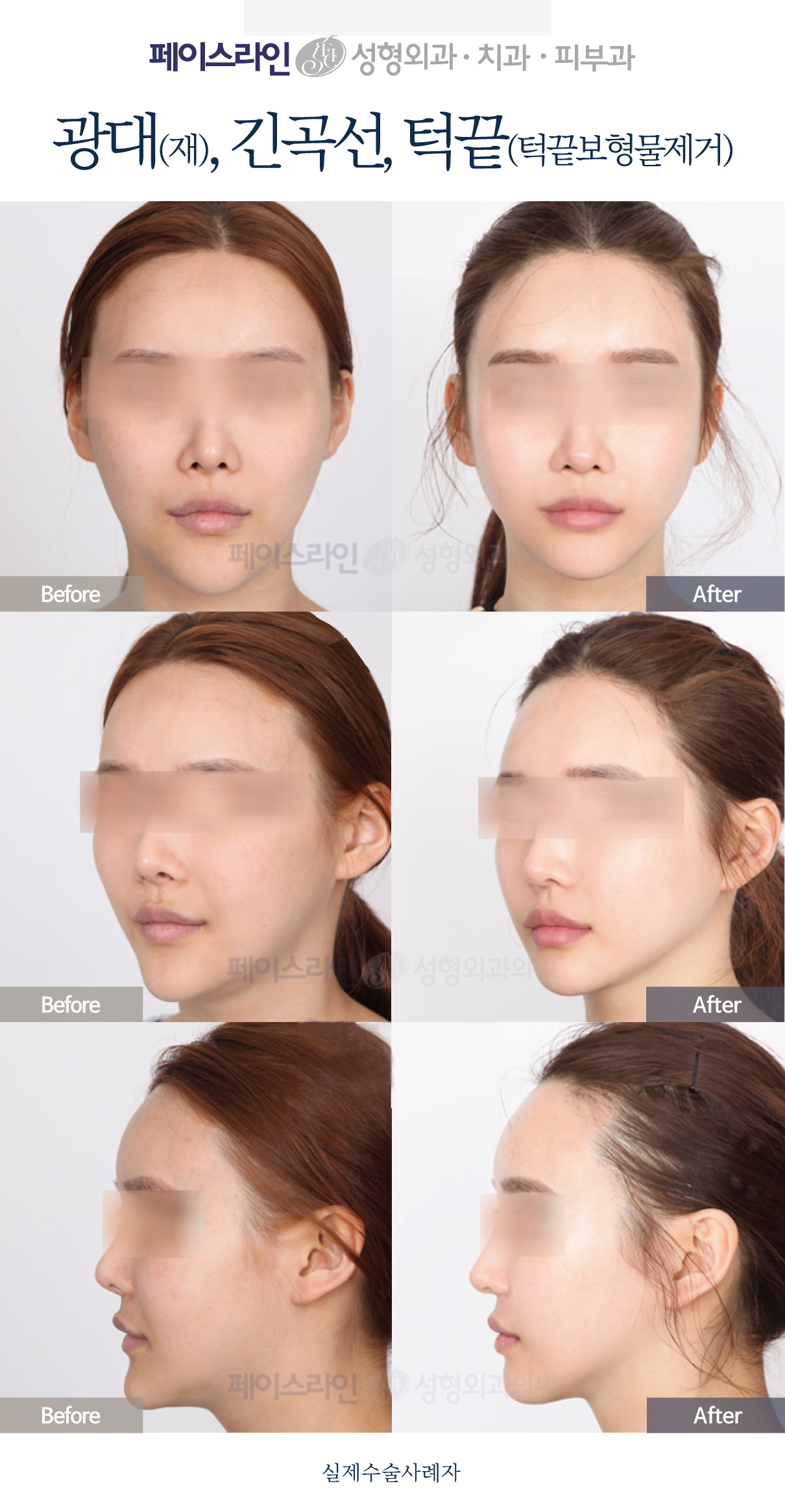 Revision cheekbone surgery with chin implant removal before and after at Faceline Plastic Surgery
