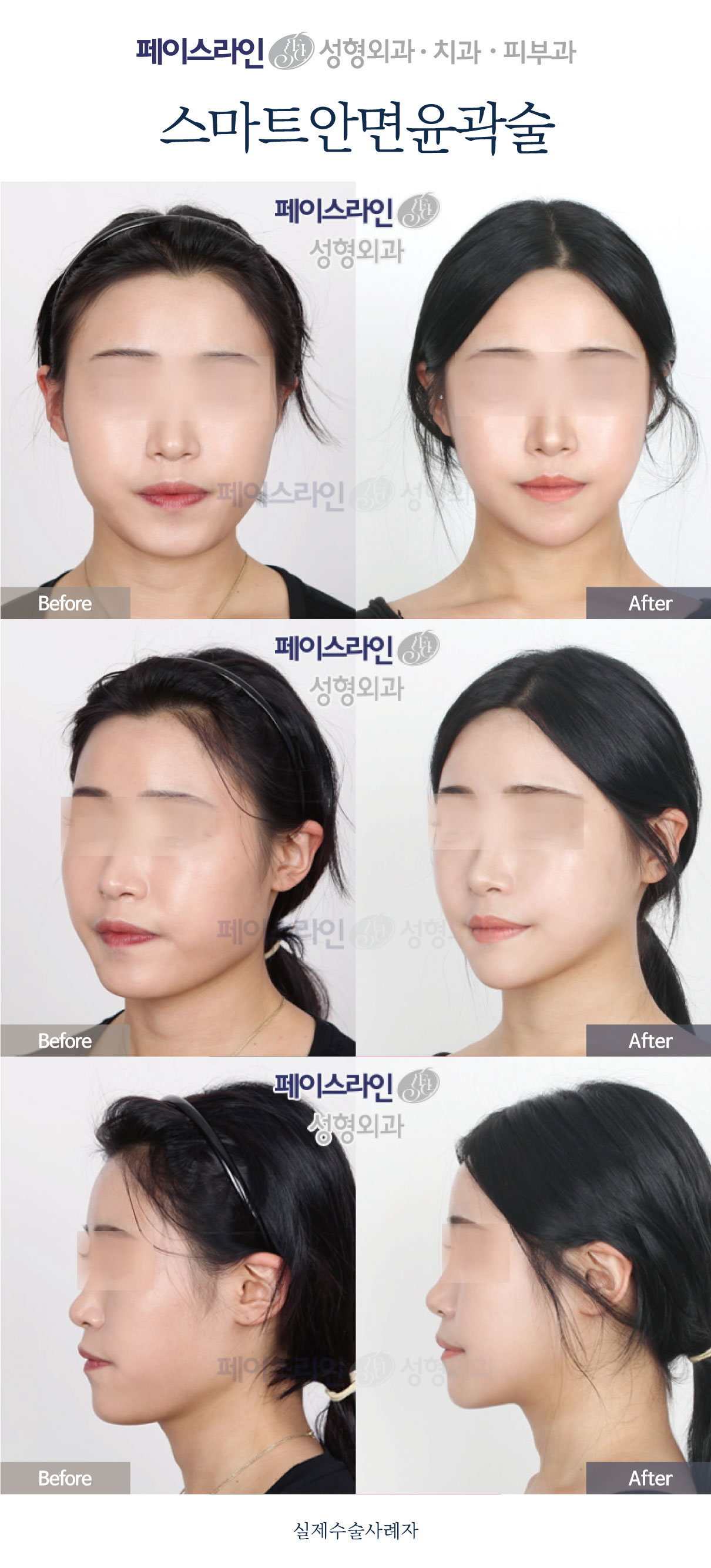 Smart facial contouring: comparison 01 before and after at Faceline Plastic Surgery