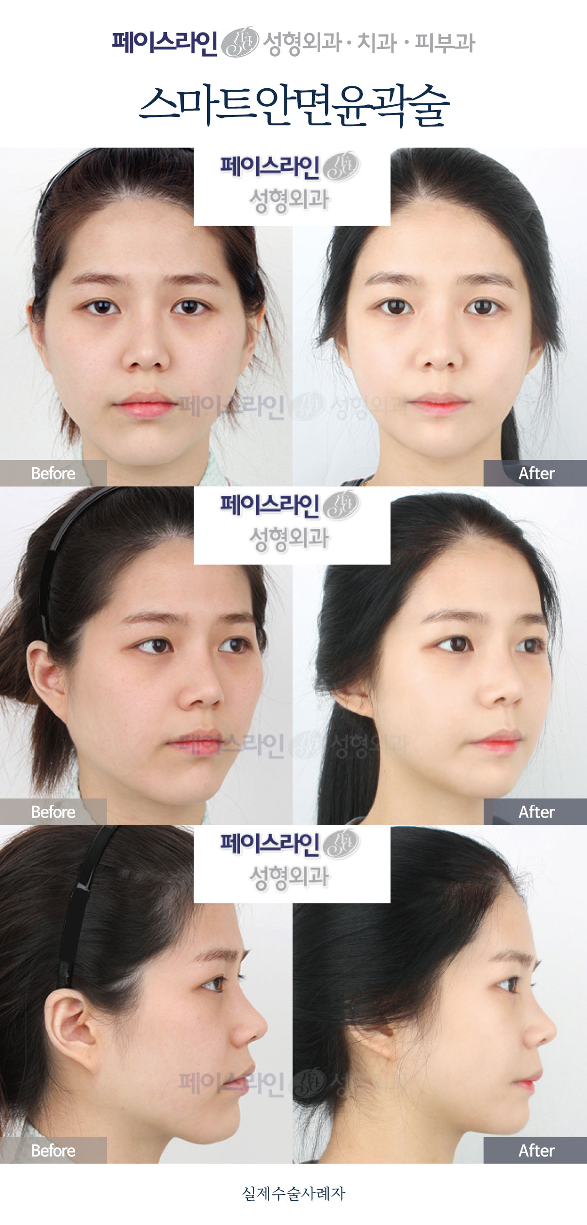 Smart facial contouring: comparison 02 before and after at Faceline Plastic Surgery