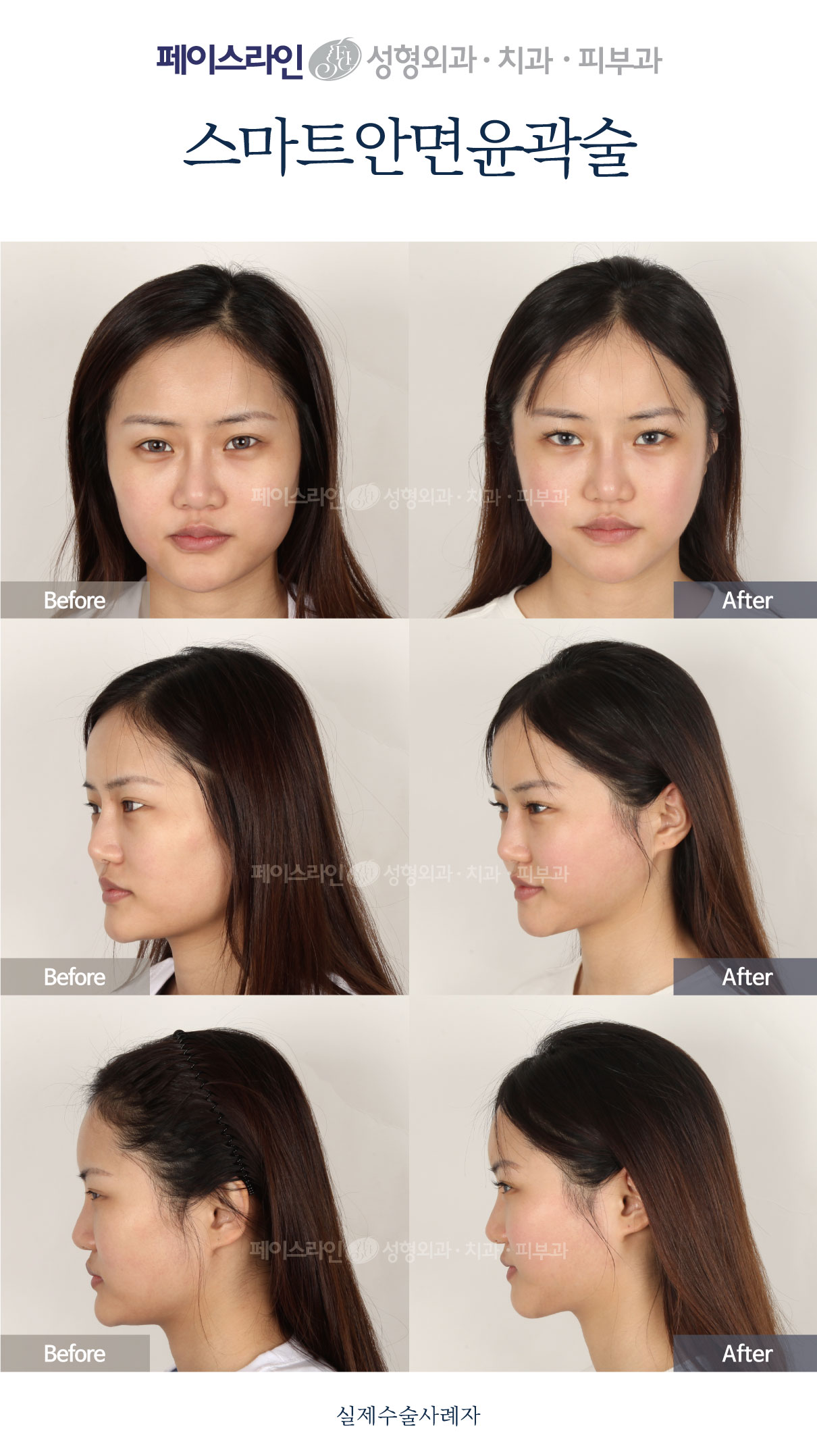 Smart facial contouring: comparison 03 before and after at Faceline Plastic Surgery