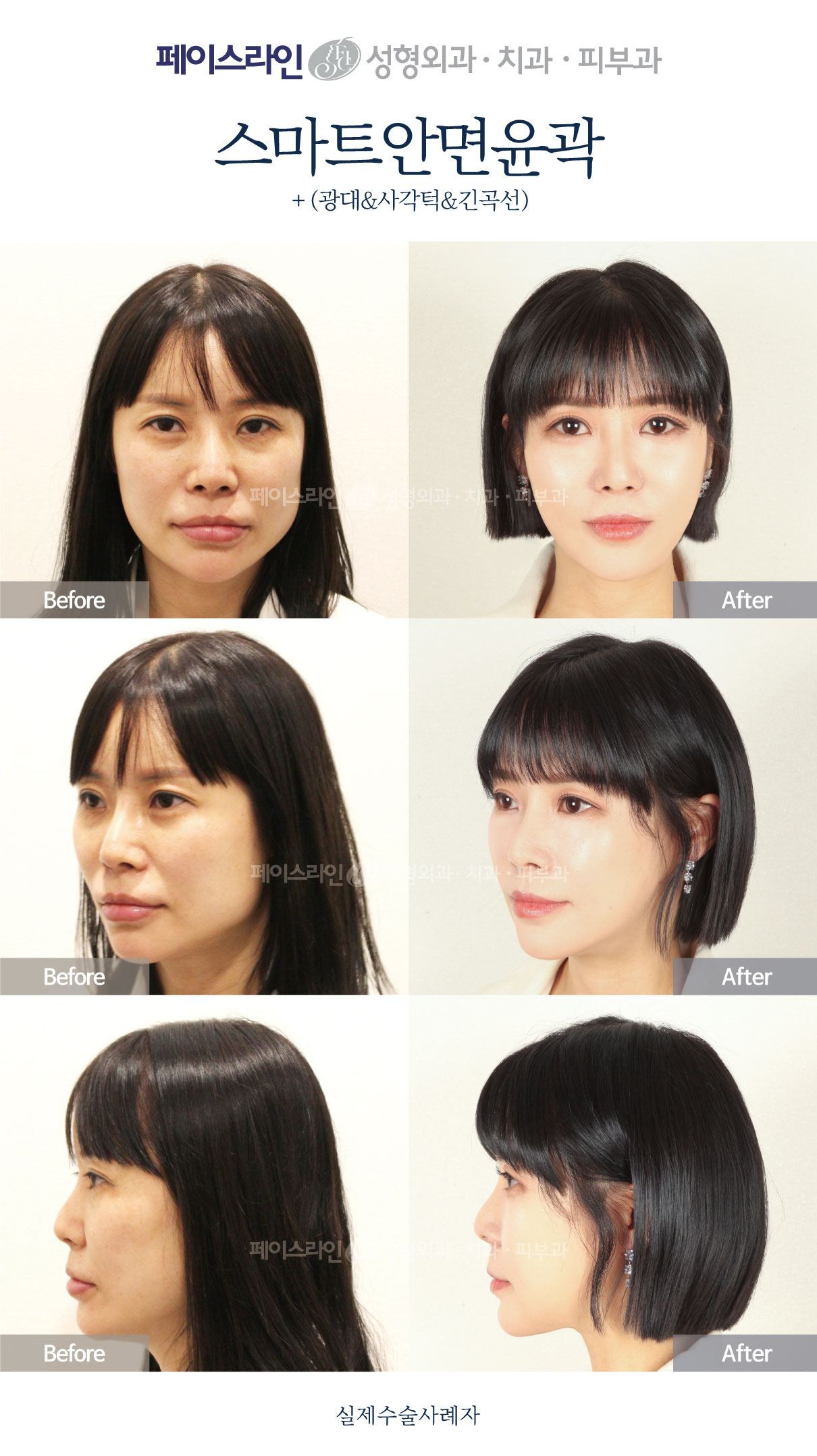 Smart facial contouring with cheekbone and jaw procedures before and after at Faceline Plastic Surgery