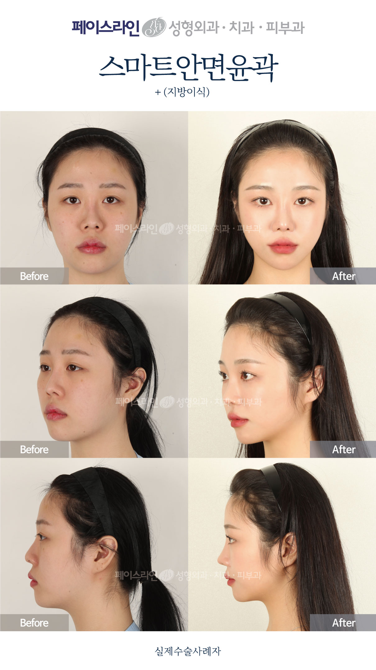 Smart facial contouring with fat grafting before and after at Faceline Plastic Surgery