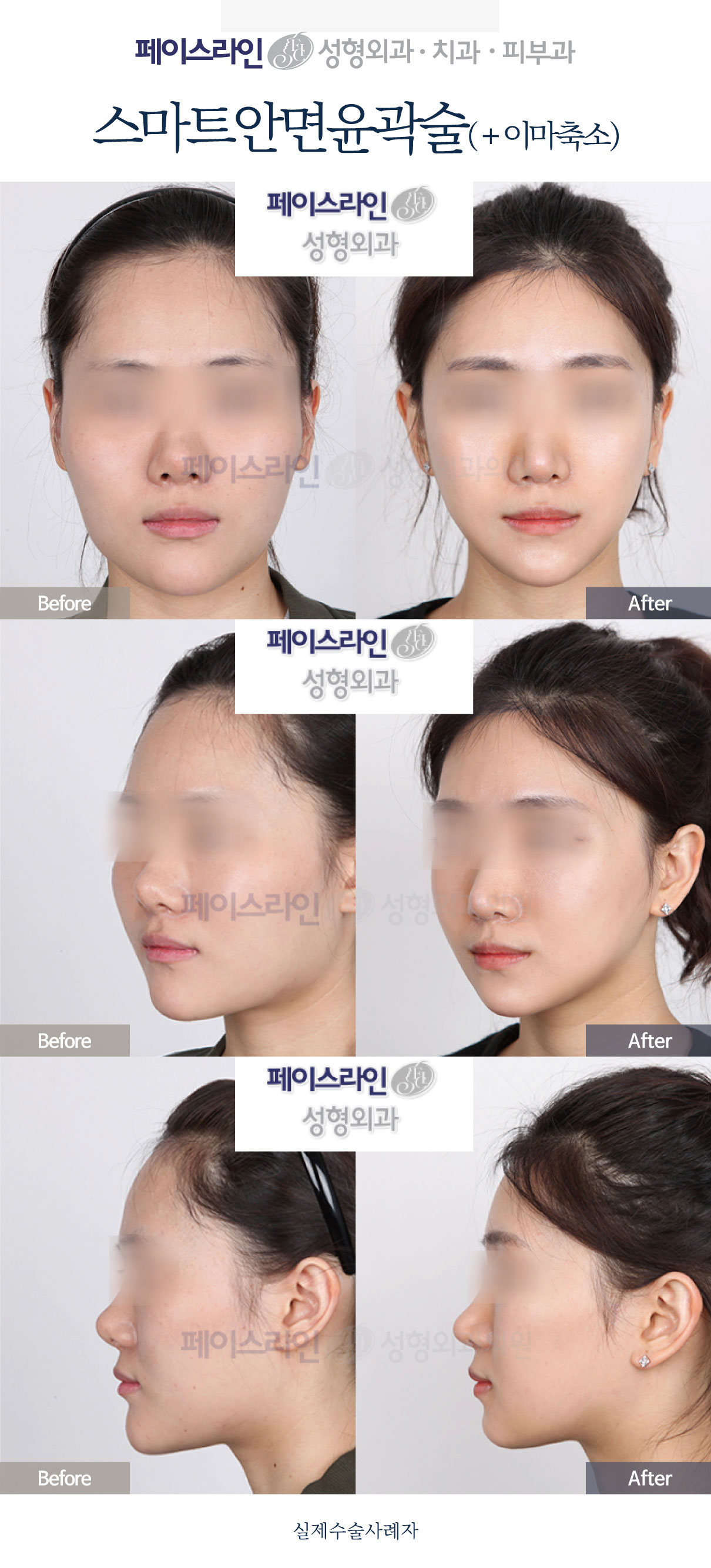 Smart facial contouring with forehead reduction before and after at Faceline Plastic Surgery