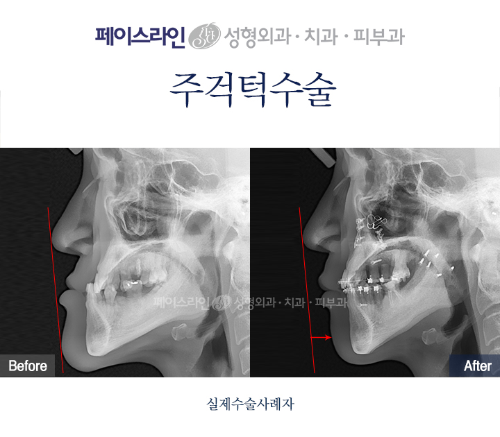 Underbite surgery: lateral X-ray comparison before and after at Faceline Plastic Surgery