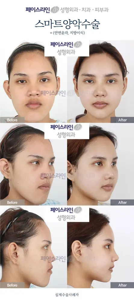Double jaw surgery with contouring and fat grafting before and after at Faceline Plastic Surgery
