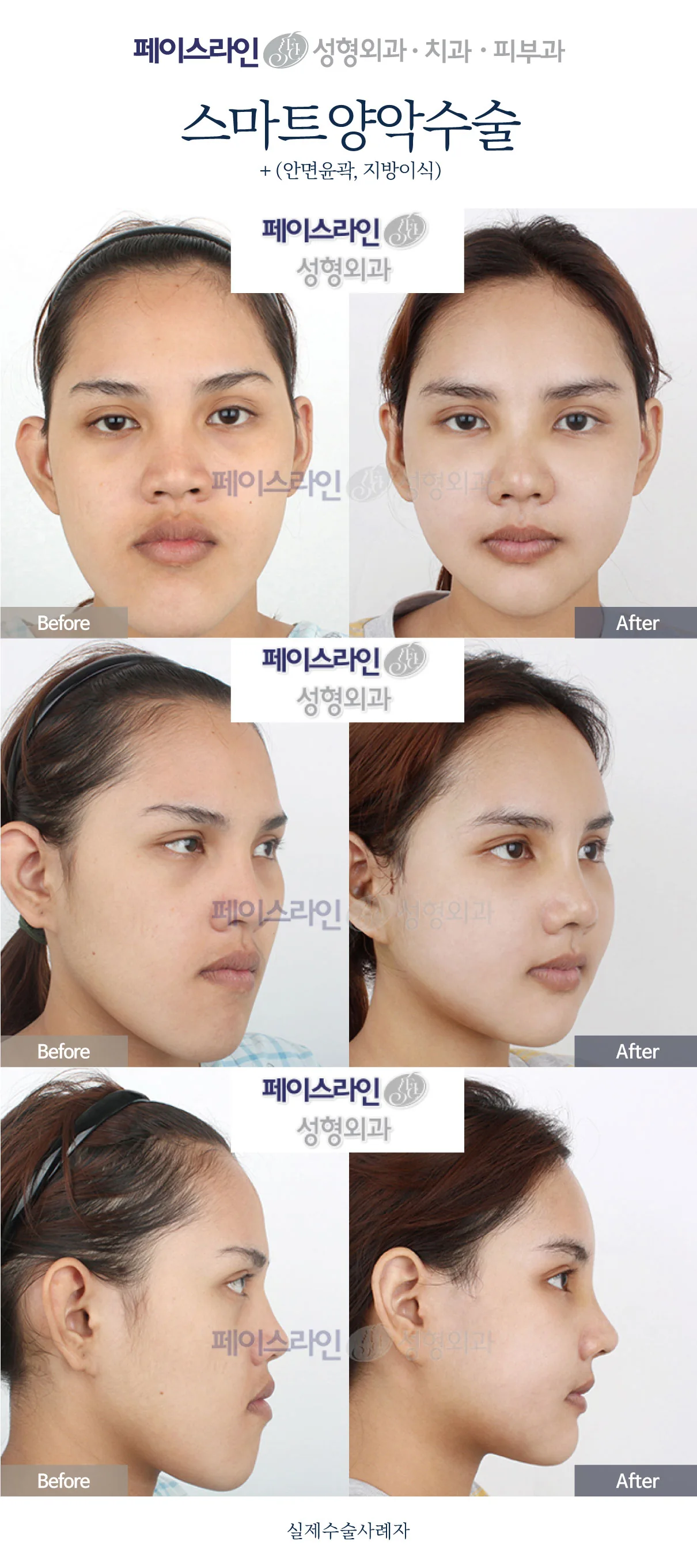 Double jaw surgery with contouring and fat grafting at Faceline Plastic Surgery: Front, angled and profile views; before on the left and after on the right.