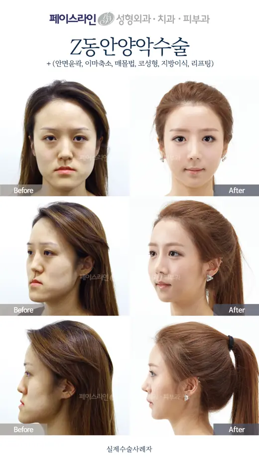 Double jaw surgery with forehead, eyelid and nose procedures before and after at Faceline Plastic Surgery