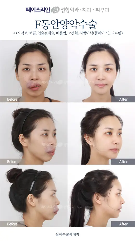 Double jaw surgery with lip reduction and facial contouring before and after at Faceline Plastic Surgery