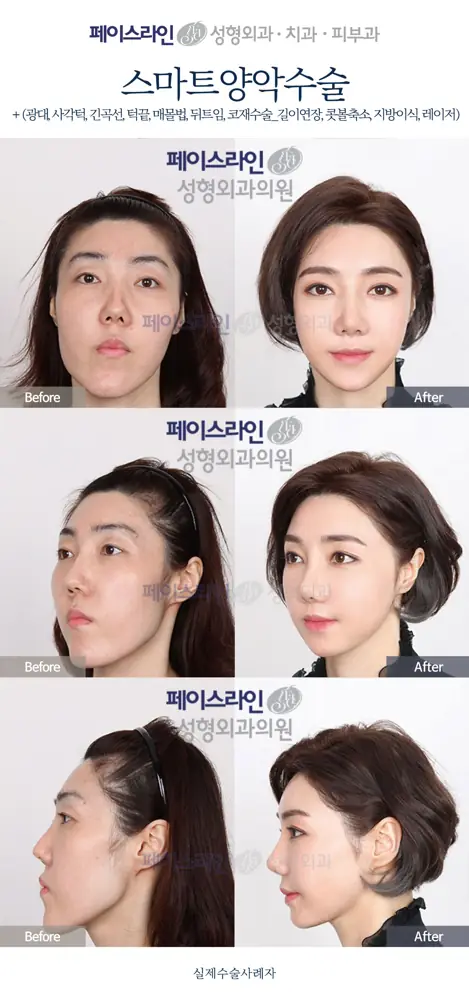 Double jaw surgery with revision rhinoplasty before and after at Faceline Plastic Surgery