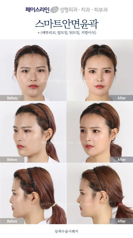 Facial contouring with nose and eye-corner surgery before and after at Faceline Plastic Surgery