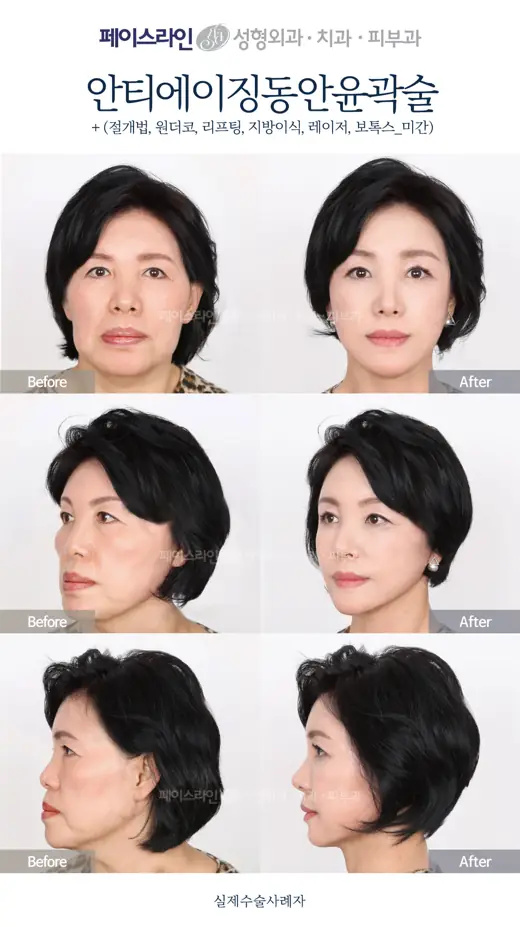 Facial contouring with eyelid surgery and rejuvenation before and after at Faceline Plastic Surgery